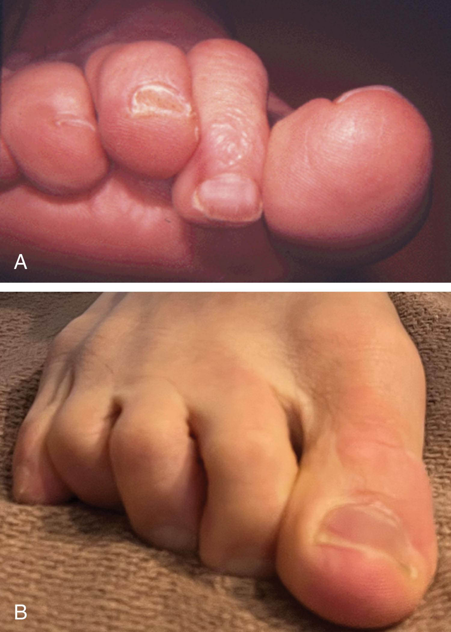 Fig. 9-34, With a tight flexor tendon in an adjacent toe, a flexor tenotomy should be performed at the time of hammer toe repair. A , Contracture of just the second toe indicates a flexor tenotomy is possibly not necessary. B , A contracture is noted in all of the lesser toes.