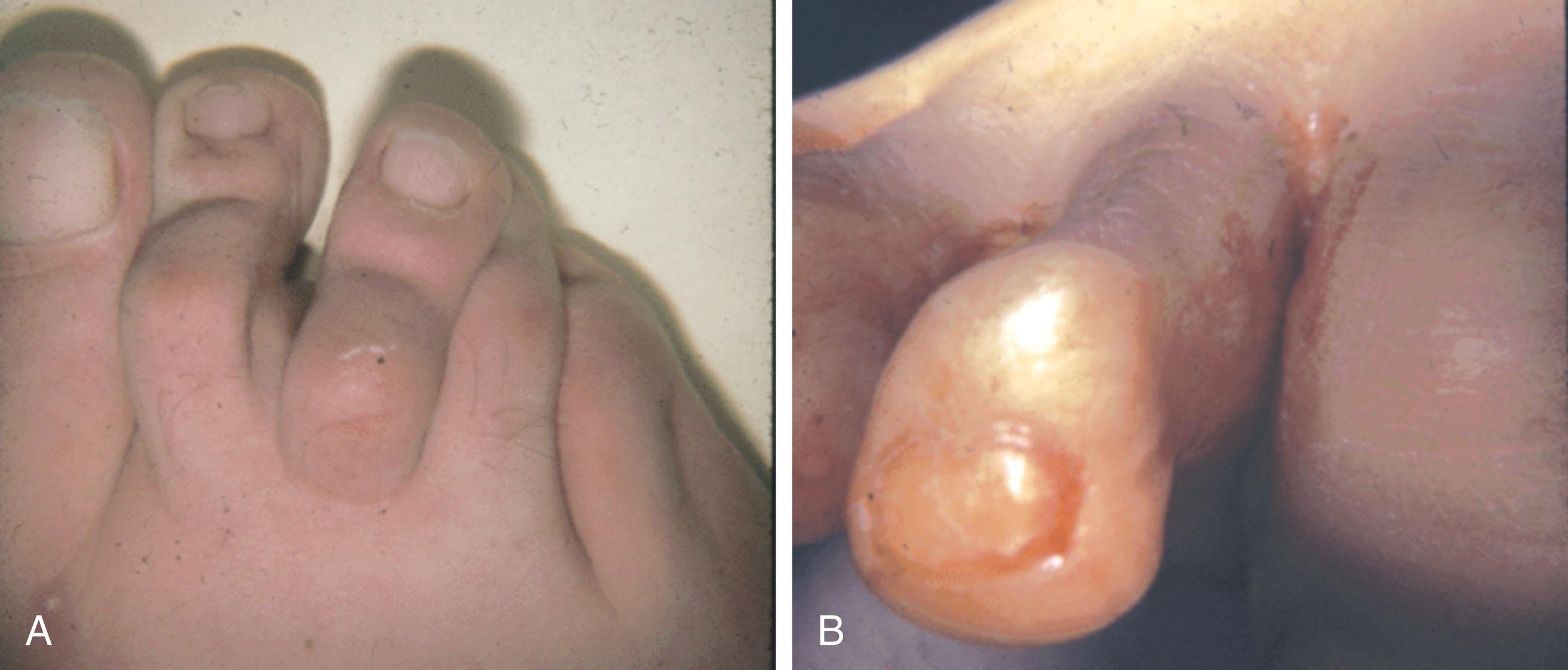 Fig. 9-37, A , Traumatic boutonnière deformity of the second toe. B , A traumatic swan-neck deformity has occurred with development of a mallet toe as well as hyperextension of the proximal interphalangeal joint.
