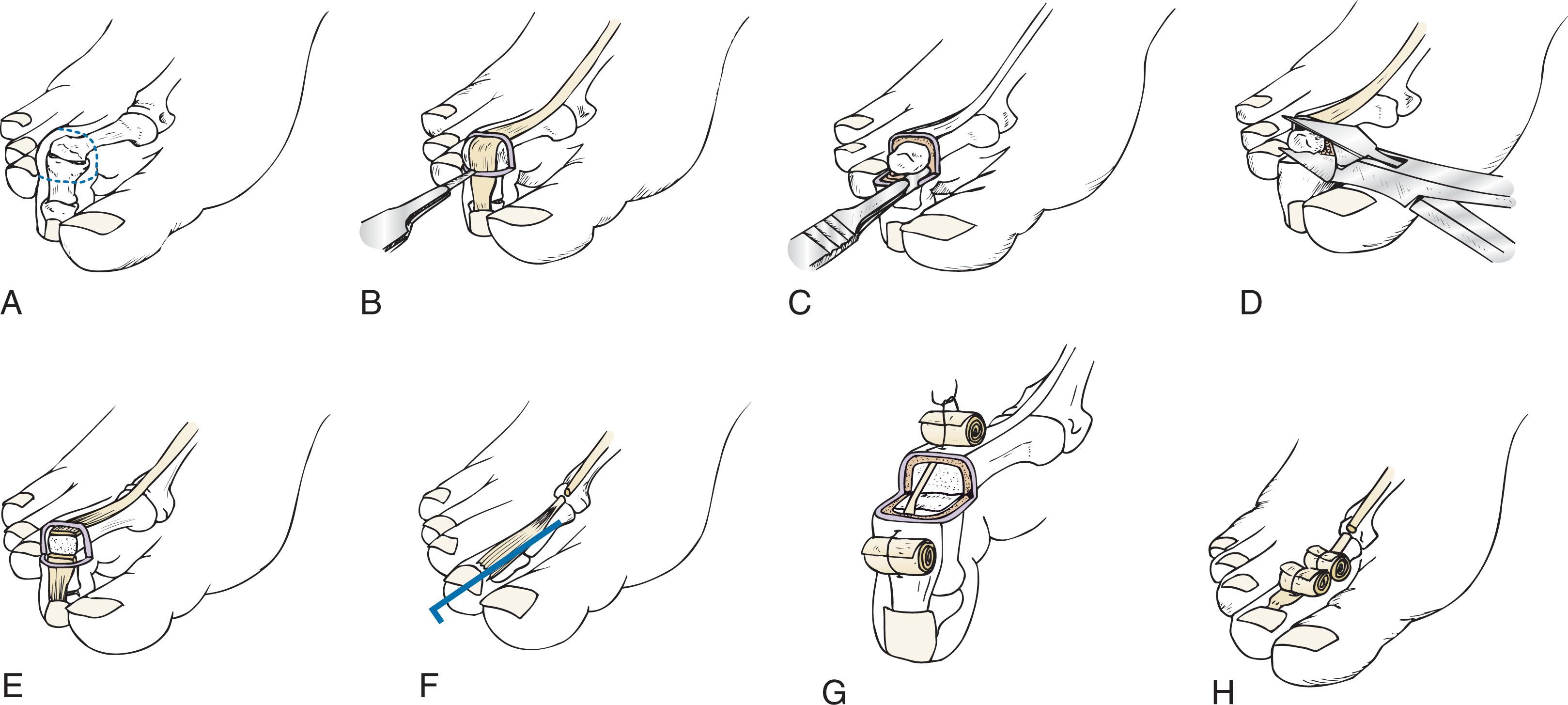 Fig. 9-39, Technique for repair of a hammer toe deformity. A , Elliptic incision over the proximal interphalangeal (PIP) joint excises callus, if present, along with the extensor tendon and joint capsule. B , Removal of extensor tendon and joint capsule along lines of incision. C , When a knife blade is placed flat against the condyles, the collateral ligaments are cut, thereby delivering the head of the proximal phalanx into the wound. D , Excision of the head of the proximal phalanx proximal to the flare of the condyles. E , Condyles have been removed. At this time, a decision is made as to whether to perform a flexor tenotomy. If a flexor tenotomy is done, the plantar capsule is incised, and the long flexor tendon is incised in the depths of the wound. F , A 0.045-inch Kirschner wire is introduced at the proximal interphalangeal (PIP) joint and driven distally, exiting the tip of the toe. The proximal interphalangeal (PIP) joint is reduced, and the pin then is driven retrograde, stabilizing the repair. G , Alternative means of stabilization. Insertion of vertical mattress suture of 3-0 nylon. The deep portion of the suture approximates the extensor tendon, and the superficial portion of the suture coapts skin edges. The Telfa bolster is used to gain leverage to hold the toe in satisfactory alignment. H , The toe is held in satisfactory alignment after placement of sutures and bolsters.