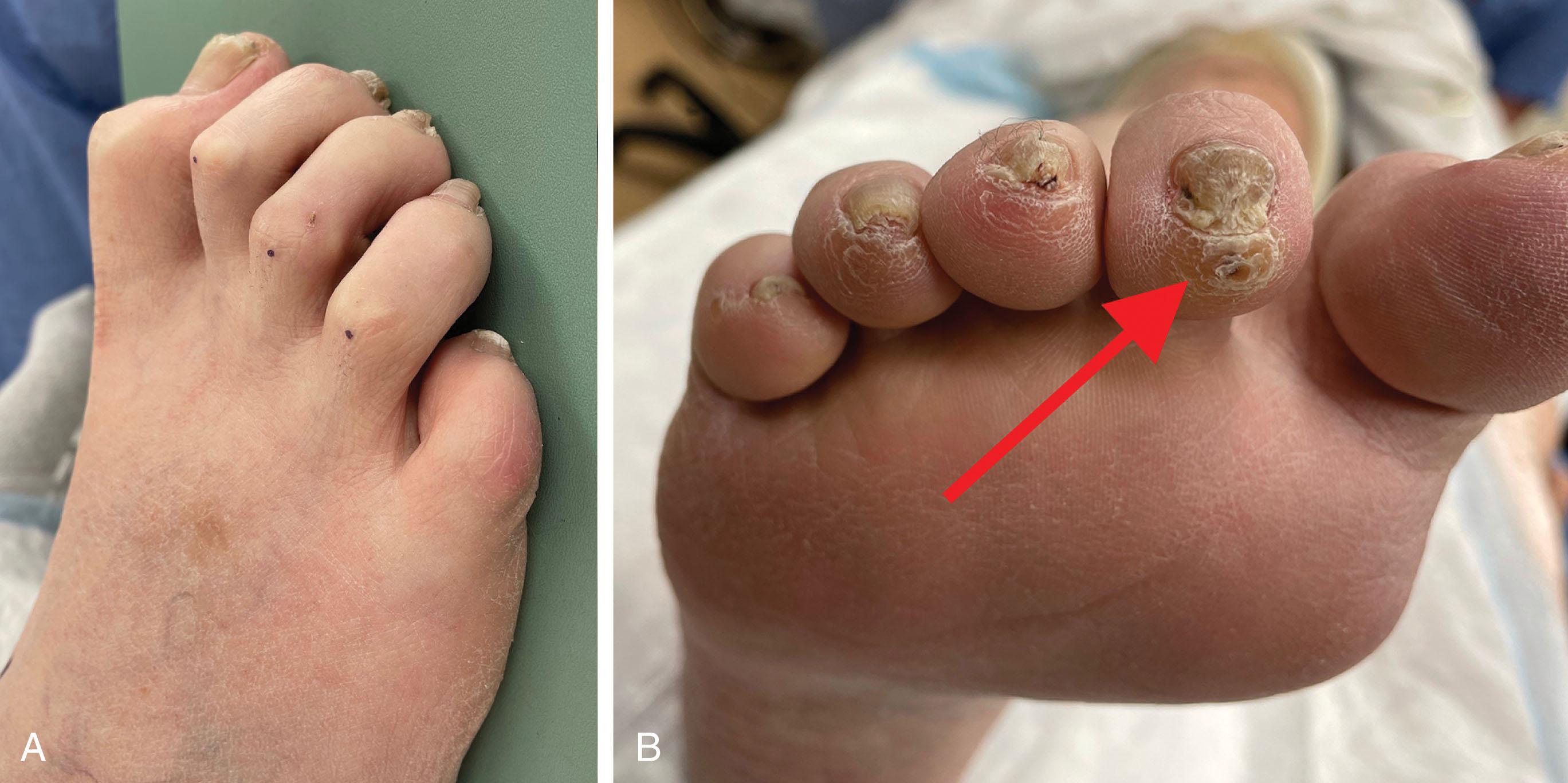 Fig. 9-4, A and B , Photographs of claw toe deformities involving hammer toe deformity associated with dorsiflexion of the metatarsophalangeal joint, and flexion of the distal interphalangeal (DIP) joint and associated painful callus and nail deformation (red arrow) . Also note the associated IP flexion contracture of the great toe.