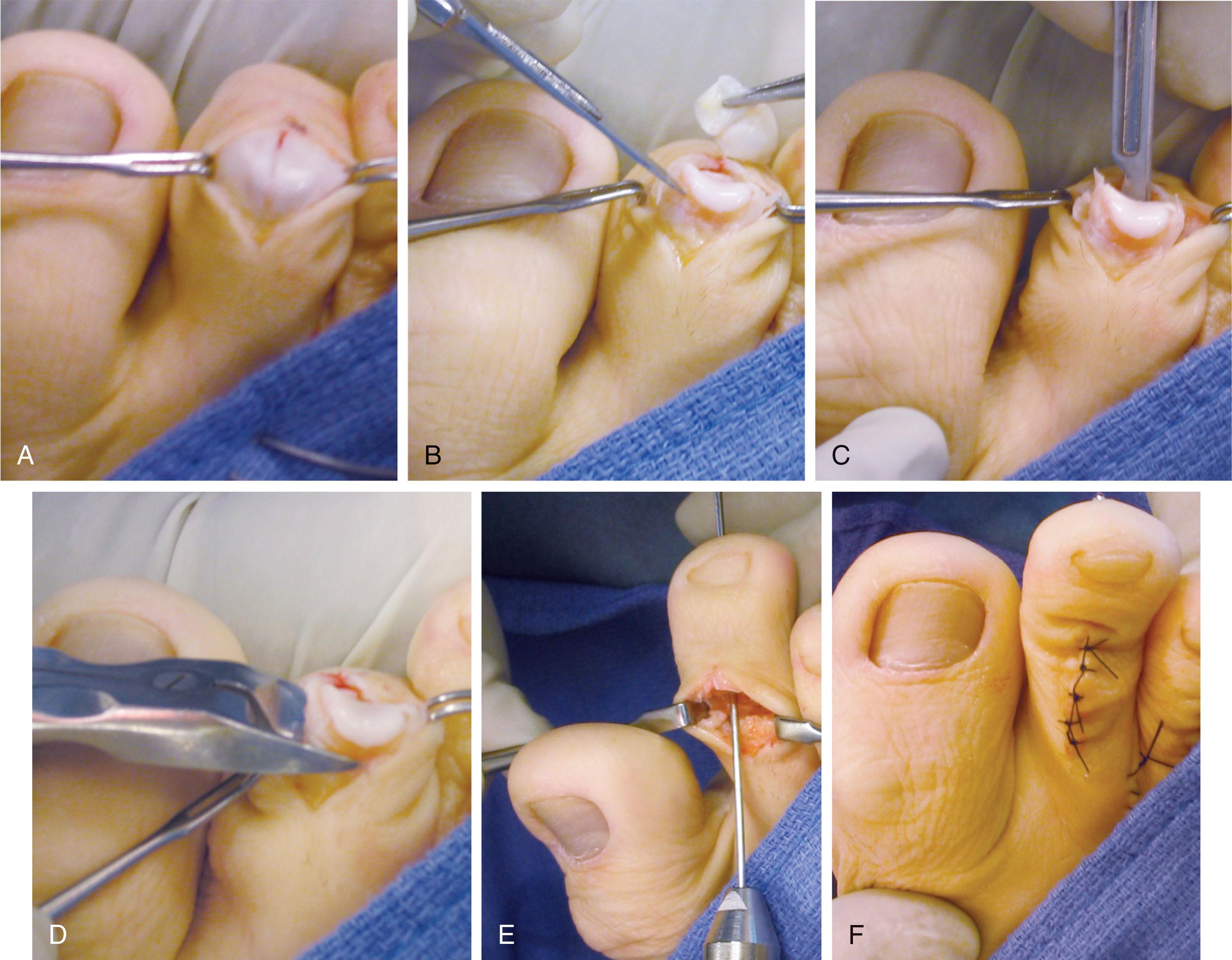 Fig. 9-40, Hammer toe deformity of the second toe. A , After a longitudinal skin excision, the dorsal capsule and extensor tendon are exposed. B , Removal of extensor tendon and joint capsule along the lines of the incision. C , The collateral ligaments and plantar capsule are released. D , Exposing the condyles of the proximal phalanx, which are excised. (After excision of the head of the proximal phalanx, a flexor tenotomy may be performed; also, the articular surface of the base of the middle phalanx may be resected.) E , Kirschner wire fixation. F , After completion of repair.