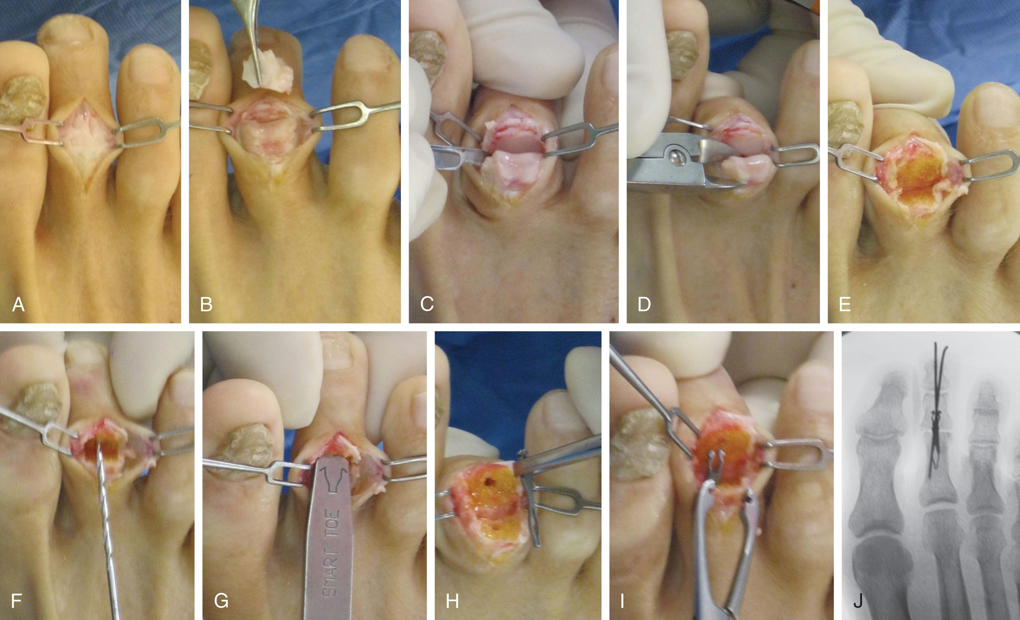 Fig. 9-45, Hammer toe repair with Nitinol implant. A , Dorsal longitudinal incision. B , Excision of dorsal capsule. C , Release of collateral ligaments. D , Resection of condyles of proximal phalanx. E , Flat surfaces are created on both middle and proximal phalangeal surfaces. F , 2-mm drill hole is placed in each of the phalanges. G , The canals are broached. H , The implant is removed from refrigerated source. I , The implant is placed in the proximal phalanx and then placed in the middle phalanx. J , Postoperative fluoroscopy showing implant and additional Kirschner wire.