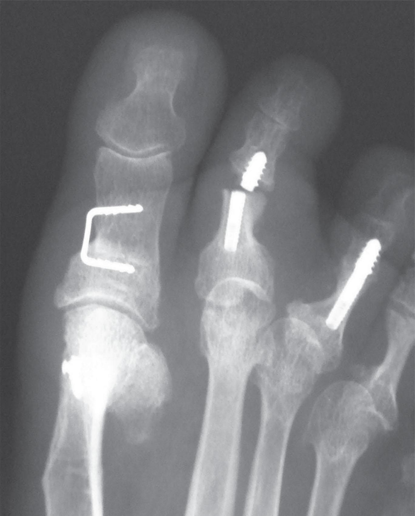 Fig. 9-46, Broken implant with recurrent deformity.