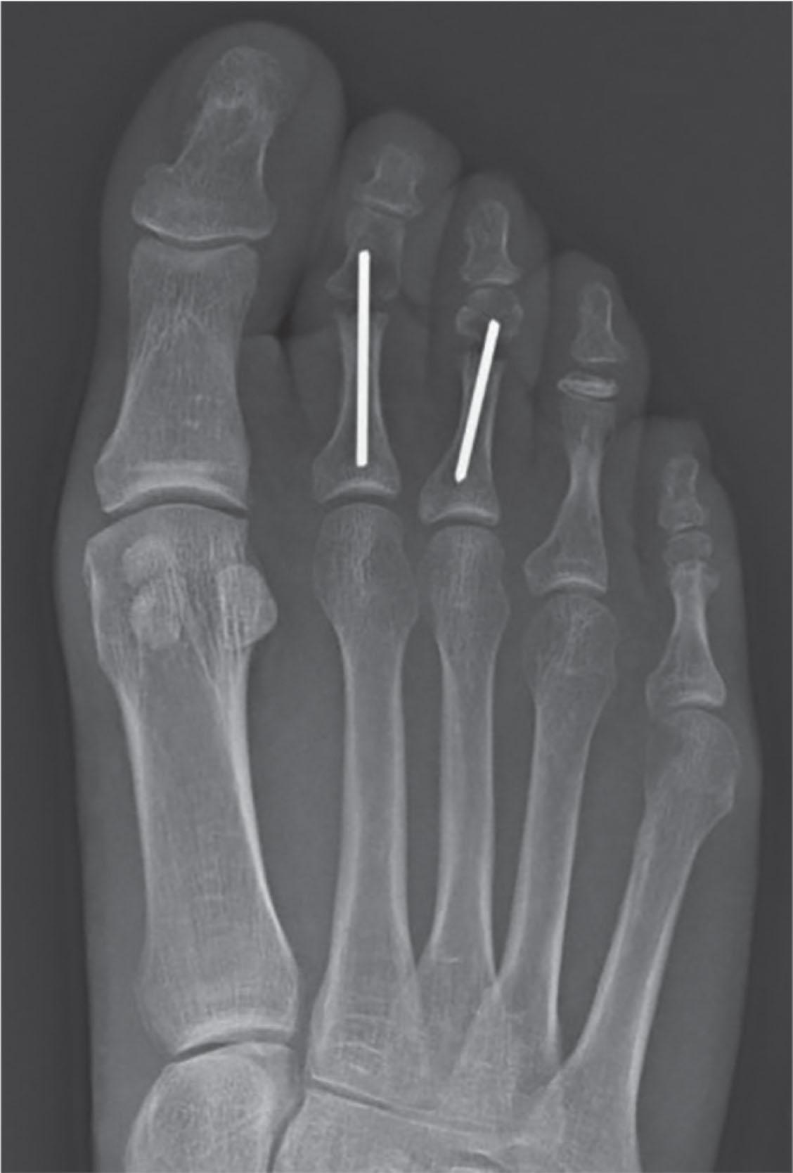 Fig. 9-47, Intramedullary fixation utilizing a 0.062 inch K wire.
