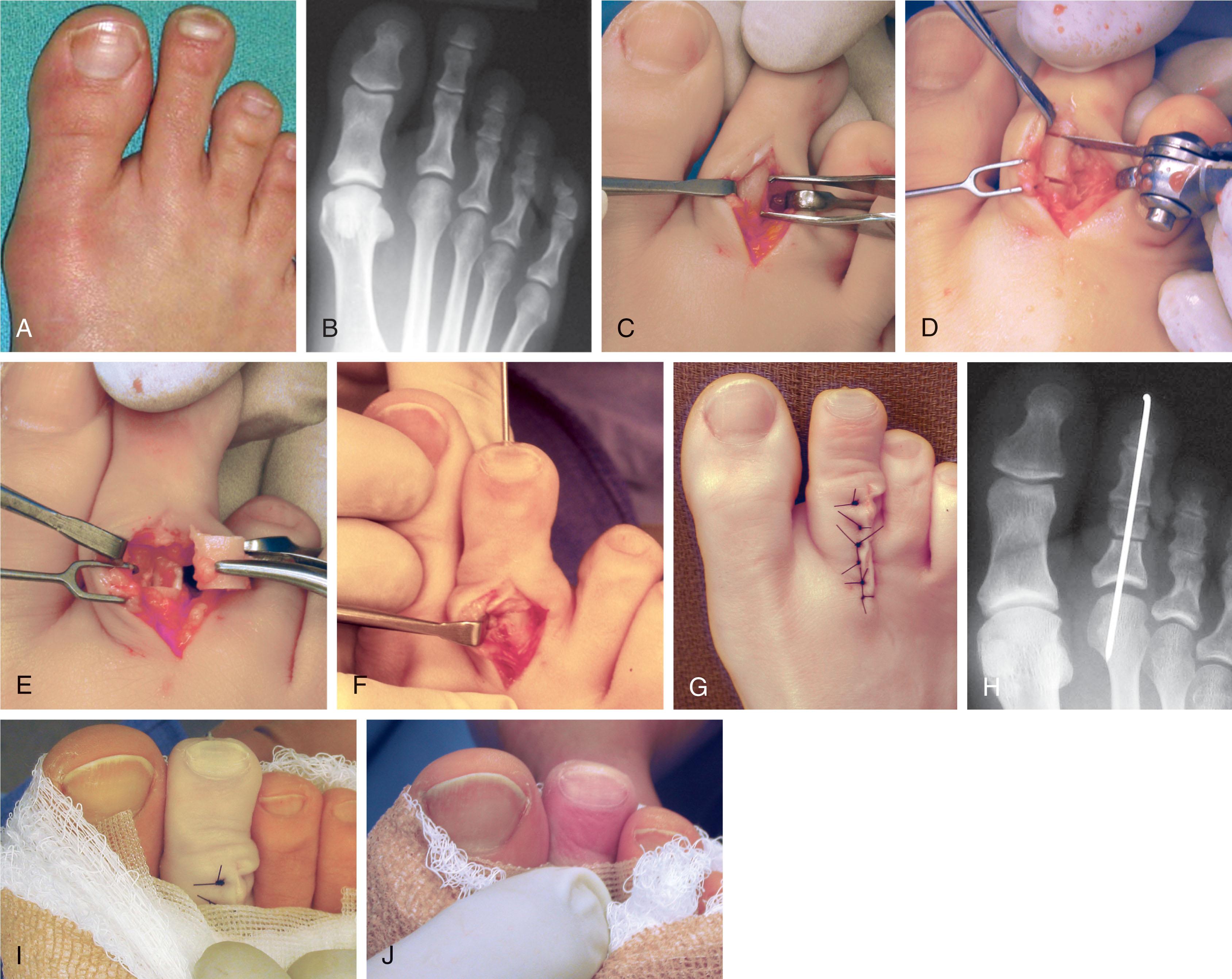 Fig. 9-48, Excessively long second toe treated with diaphysectomy. Preoperative clinical (A) and radiographic (B) appearance. C , Dorsal phalangeal exposure with proposed excision. D , Sagittal saw is used for careful resection. E , Removal of 5-mm diaphyseal segment. F , Kirschner wire fixation. G , After skin closure. H , Postoperative radiograph demonstrating shortening of digit. I and J , Evaluation of postoperative vascularity is important. Capillary filling may be slow and should be monitored.