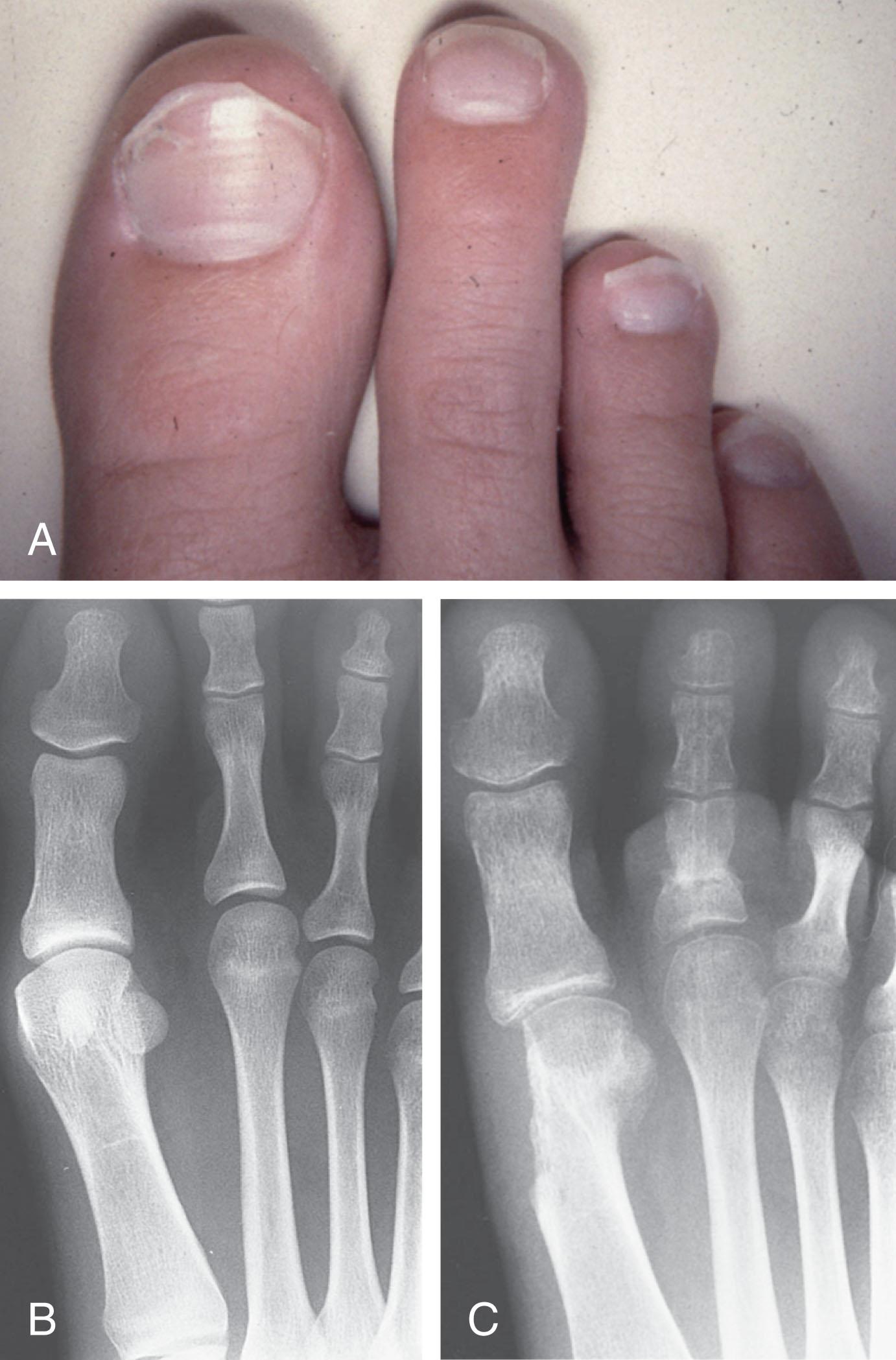 Fig. 9-49, Preoperative clinical (A) and radiographic (B) views of patient with hammer toe symptoms and an unusually long second ray. C , Long-term radiographic follow-up after diaphysectomy of the proximal phalanx.