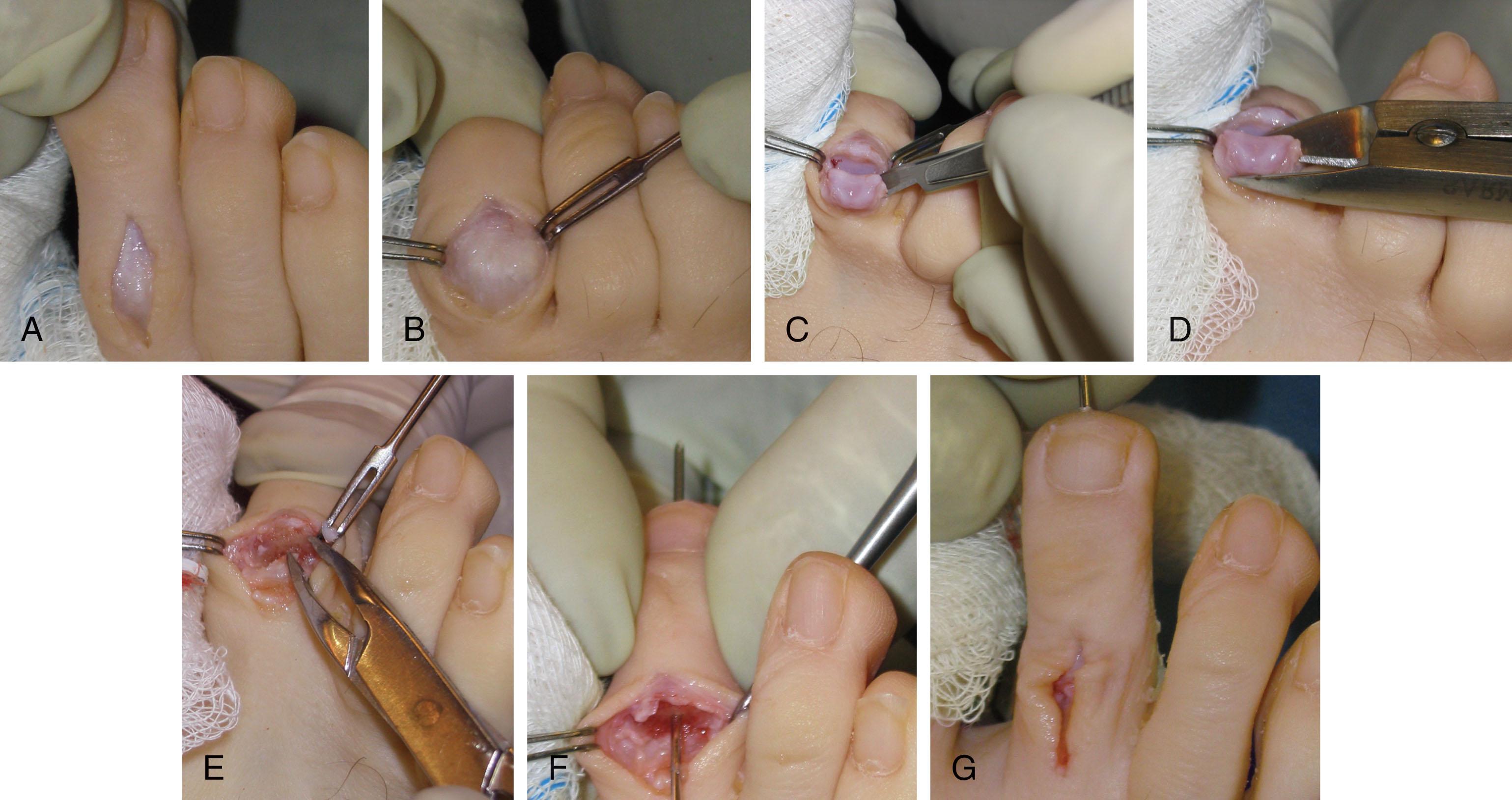 Fig. 9-76, Repair of claw toe deformity. Longitudinal incision is centered over the proximal interphalangeal joint (A) , exposing the skin, extensor tendon, and capsule (B) , which is excised. C , The toe is flexed and the plantar capsule is released. The collateral ligaments are released from the medial and lateral border of condyles. D , The condyles of the proximal phalanx are removed with a bone-cutting forceps. E , If an arthrodesis is desired, the articular surface of the base of the middle phalanx is removed. F , A 0.045-inch Kirschner wire is introduced at the arthroplasty site and driven distally. G , With the toe reduced, the Kirschner wire is driven in a retrograde fashion, stabilizing the proximal phalanx. After skin closure, the toe is adequately aligned.