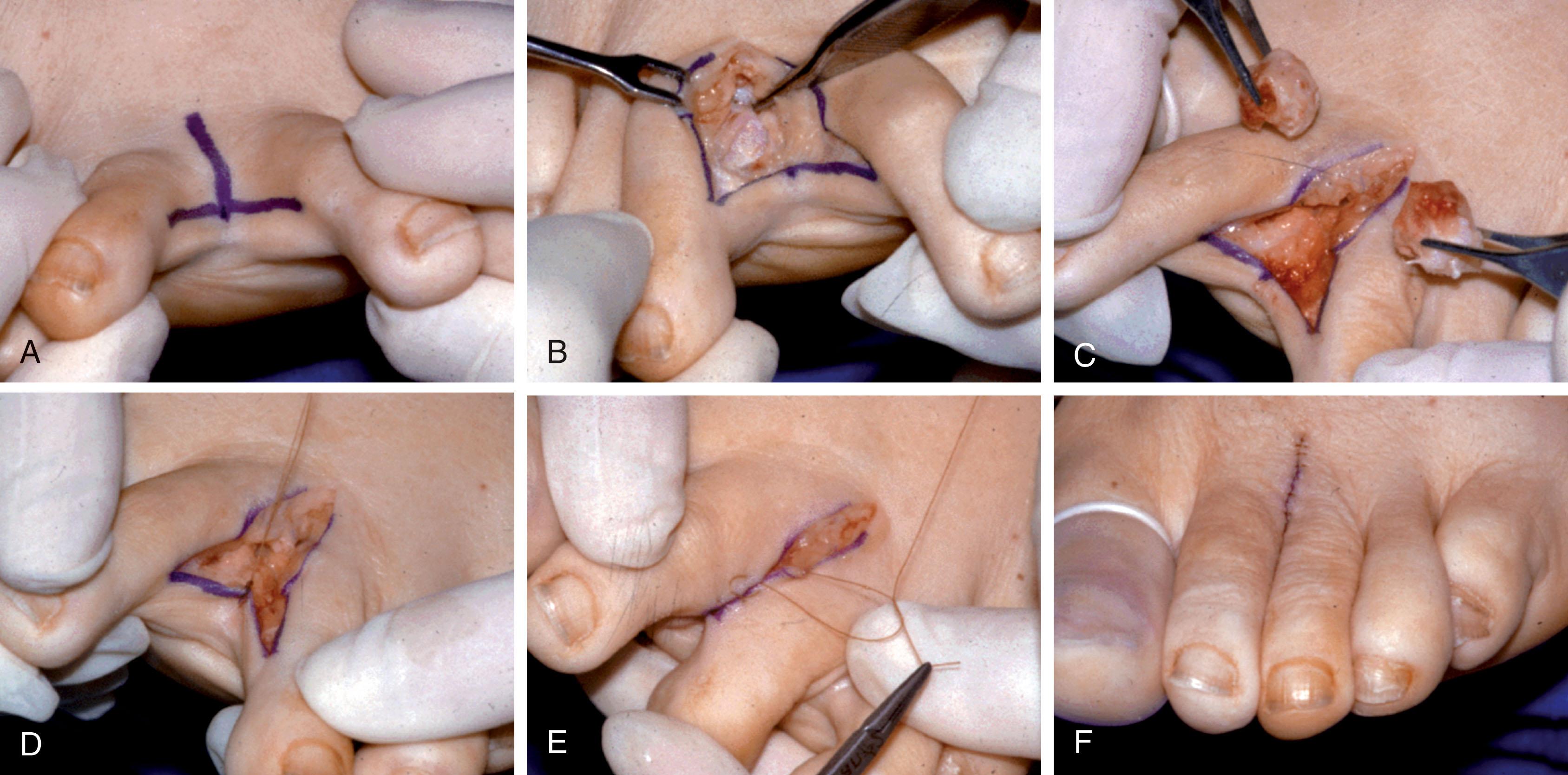 Fig. 9-50, With a partial proximal phalangectomy, the base of the proximal phalanx is excised. Often, adjacent partial proximal phalangectomies are performed in combination with syndactylization. A and B , An intramedullary web space incision is made to approach the adjacent metatarsophalangeal joints. C , The bases of the proximal phalanges of the second and third toes have been excised. D–F , Closure of deep and superficial tissue.