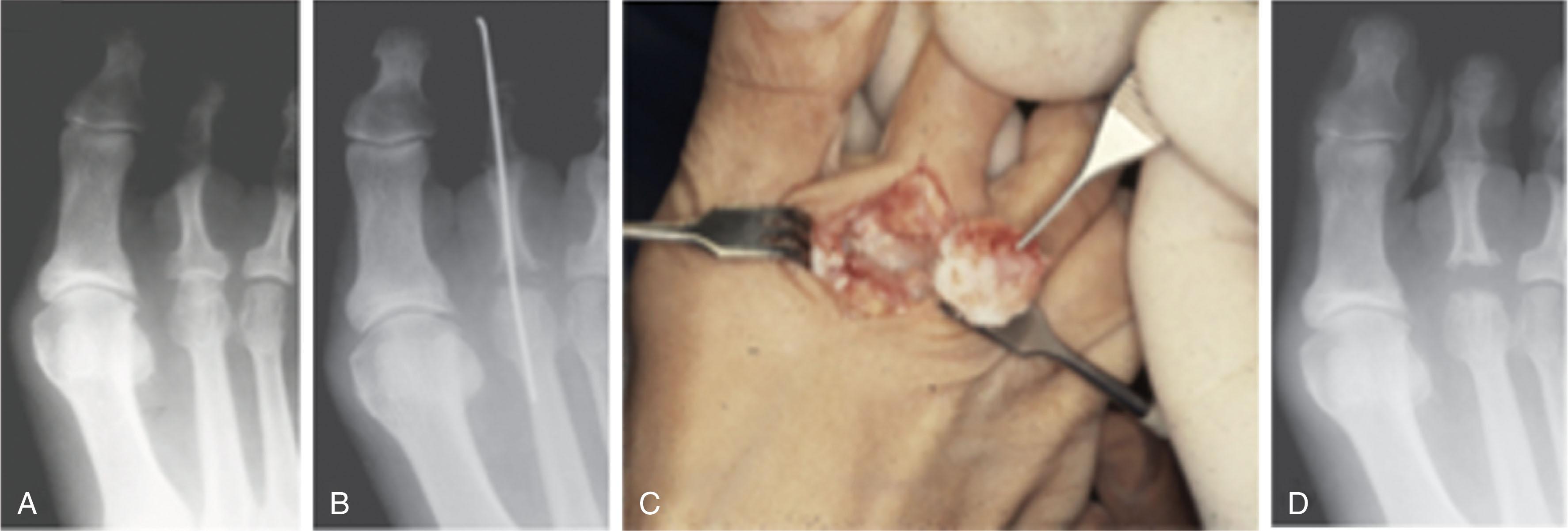 Fig. 9-51, A , Painful degenerative arthritis of the second metatarsophalangeal joint. Radiograph demonstrates complete loss of the remaining joint space. B , After excision of the base of the proximal phalanx of the second toe, an intramedullary Kirschner wire is used to stabilize the repair until adequate healing is achieved. C , Intraoperative photograph after partial proximal phalangectomy. D , After removal of Kirschner wire.