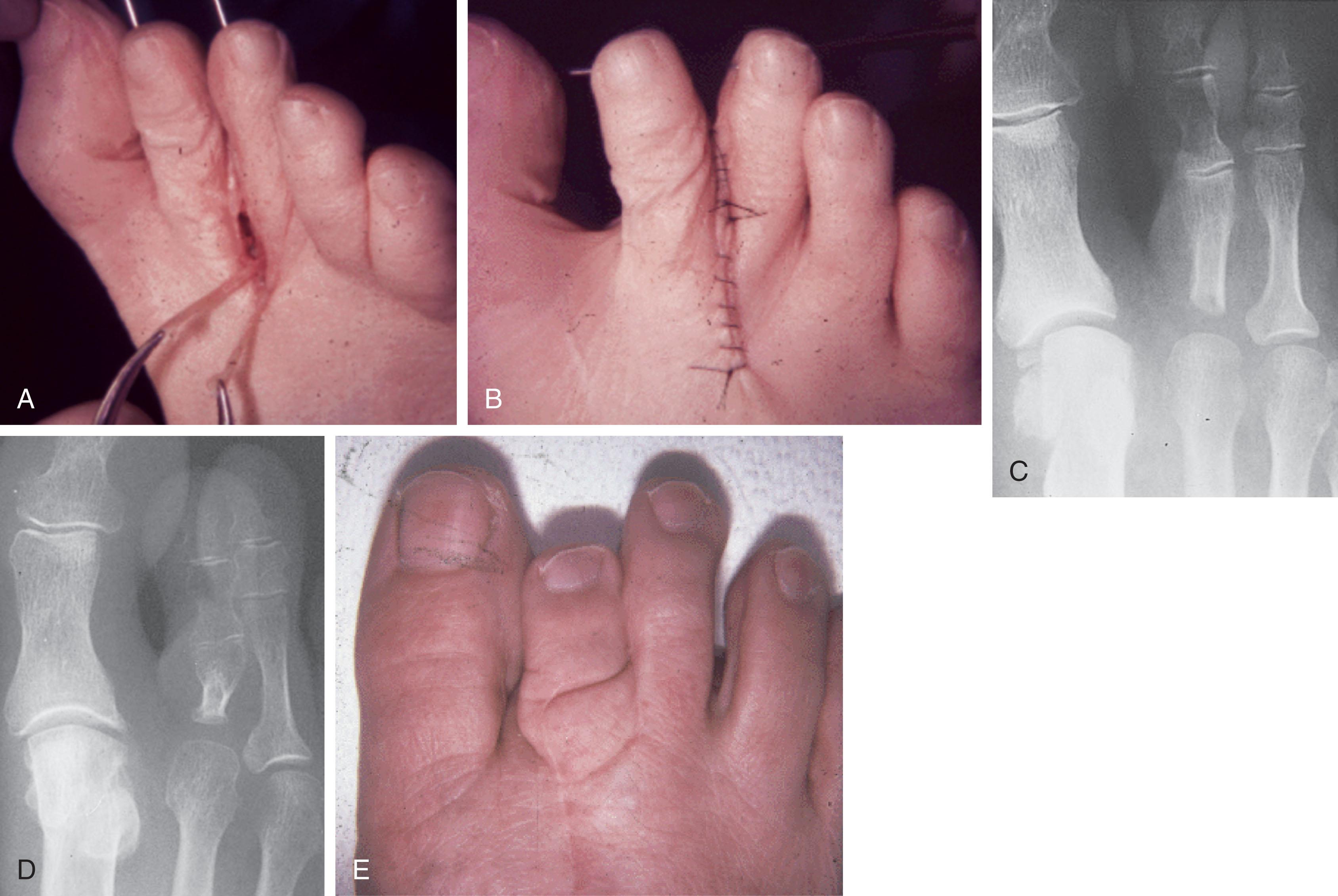 Fig. 9-52, A and B , Intraoperative photographs after Kirschner wire fixation and syndactylization after partial proximal phalangectomy of the second toe deformity. C , Radiograph immediately after surgery. D , A radiograph 5 years postoperatively demonstrates severe shortening of the proximal phalanx with a varus deformity of the third toe. E , Cosmetically unacceptable syndactylization after partial proximal phalangectomy of only the second toe.