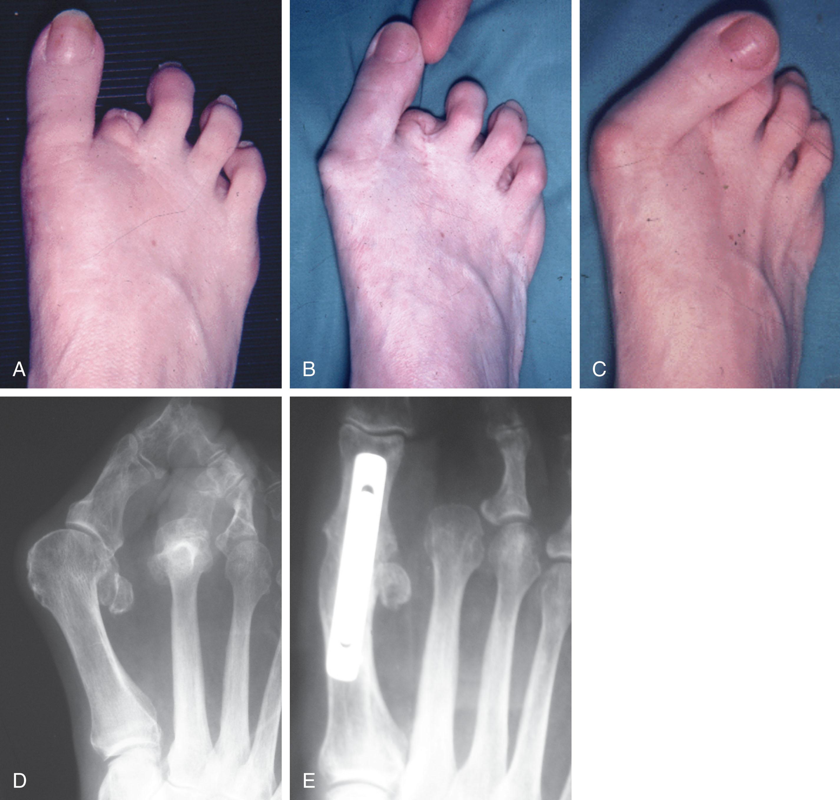 Fig. 9-53, A , After amputation of second toe. B and C , Progressive hallux valgus after amputation of second toe. D , Preoperative radiograph with hallux valgus and dislocated second metatarsophalangeal (MTP) joint. E , After MTP fusion and second toe amputation.