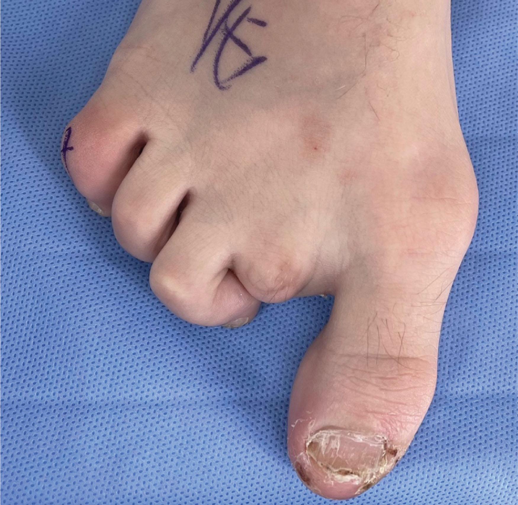 Fig. 9-54, Patient with rapid onset of adjacent claw toe deformity after second toe amputation.