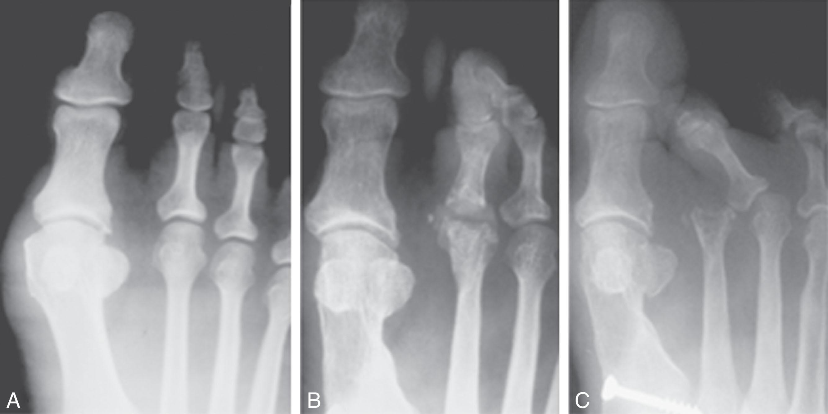 Fig. 9-55, Second metatarsophalangeal (MTP) joint silicone implant arthroplasty. A , Mild hallux valgus deformity with painful second MTP joint. B , After first metatarsal osteotomy and placement of second MTP joint double-stem silicone implant. (The implant went on to failure, with eventual salvage with a second toe amputation.) C , At long-term follow-up, the lateral lesser toes have migrated medially.
