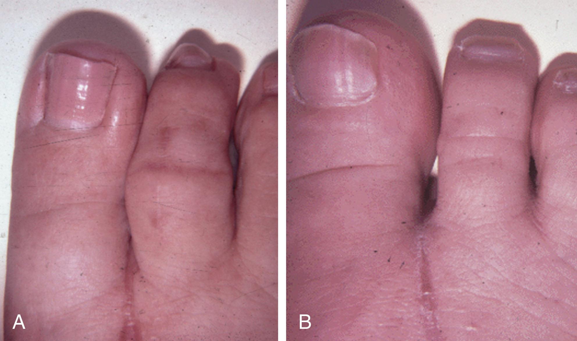 Fig. 9-56, A , Postoperative swelling is common. B , With time, edema of the toe usually subsides.