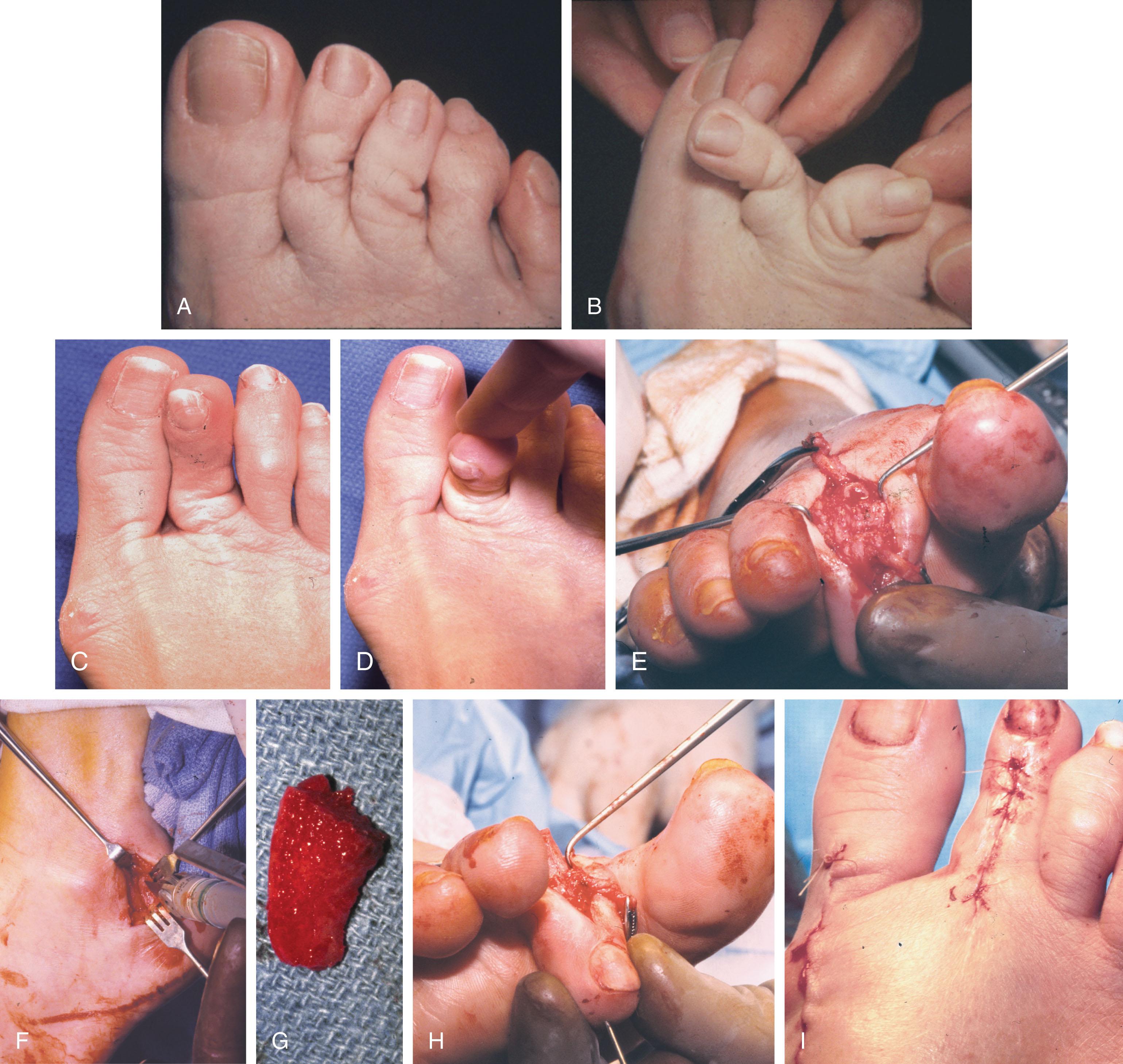 Fig. 9-57, A and B , Excessive resection of bone can destabilize the lesser toes. C and D , Unstable second toe after excessive bone resection. E , Operative exposure of area of prior resection arthroplasty. F , Calcaneal exposure to obtain graft. G , Cylindric donor graft. H , Placement of graft. I , Final clinical appearance after interposition graft. Note adequate vascularity of digit.
