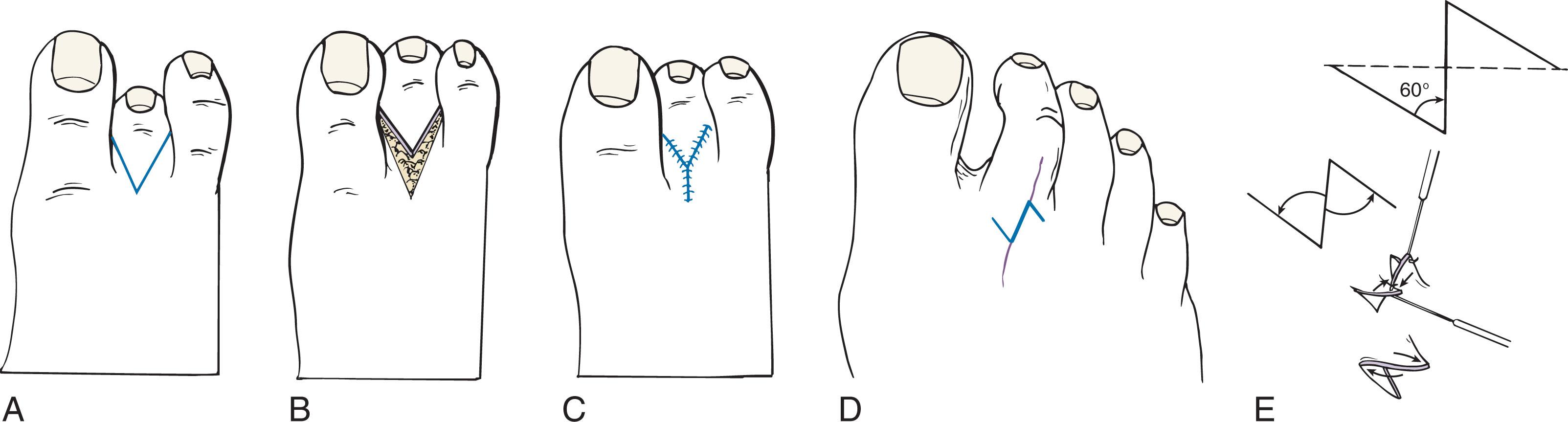 Fig. 9-58, Soft tissue V-Y plasty for contracted lesser toe. A , Proposed V-shaped skin incision. B , Operative incision. C , Closure in Y fashion to lengthen the lesser toe. D and E , Z-plasty to correct contracted lesser toes.
