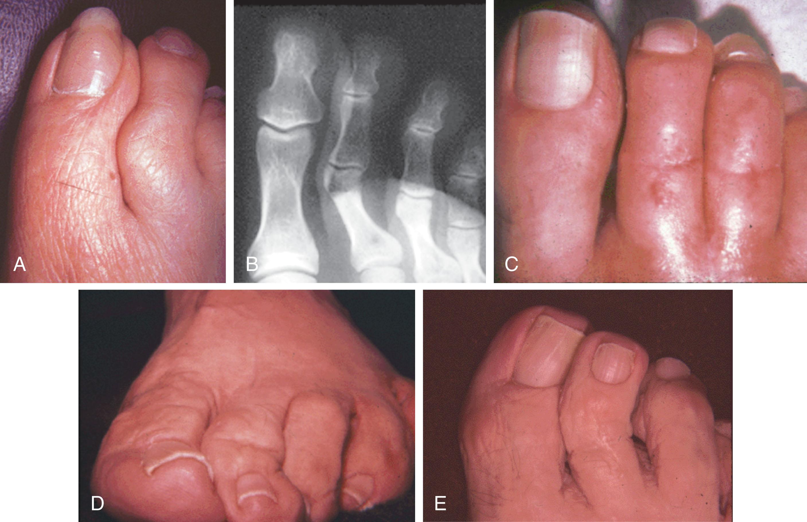 Fig. 9-59, Molding of adjacent toes. Preoperative clinical examination (A) and radiograph (B) demonstrate molding of second toe. C , Molding of the second and third toes often occurs immediately after surgery but resolves with diminution of swelling. D and E , Molding of second toe after hammer toe repair.