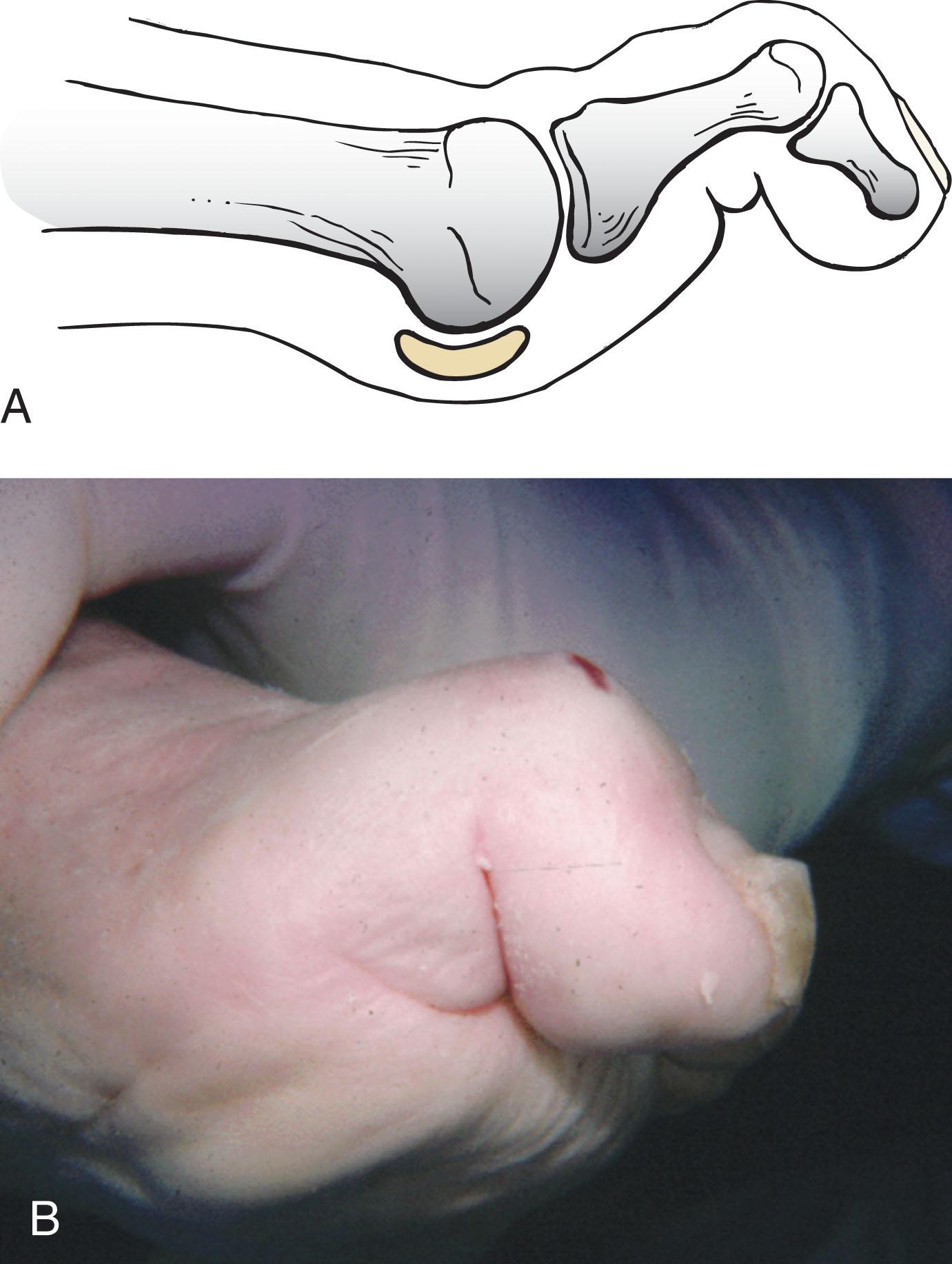 Fig. 9-5, A , Hammered great toe. Note articulation of distal phalanx with plantar surface of the head of the proximal phalanx. B , Hammer toe deformity of hallux.