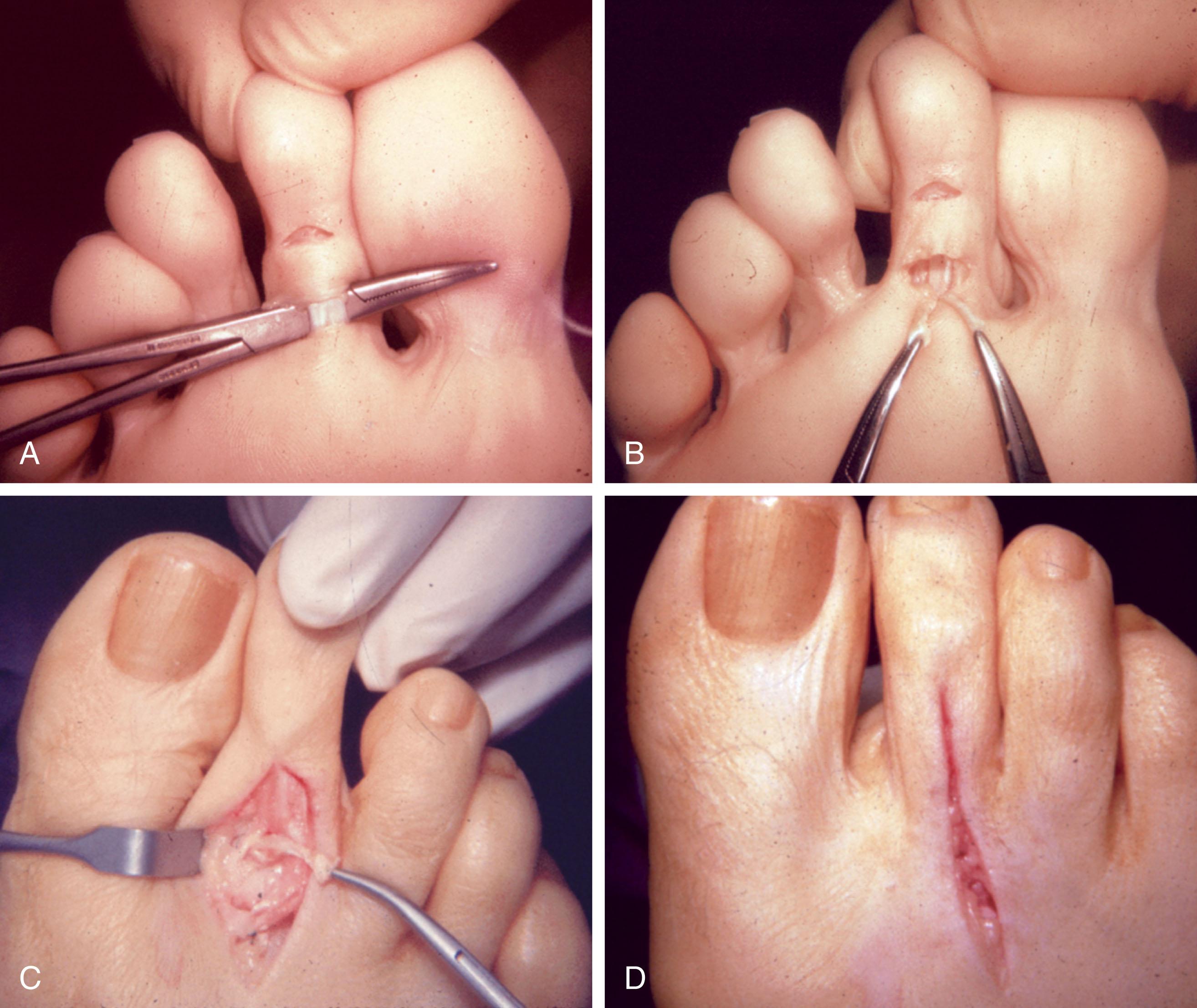 Fig. 9-63, A , Plantar view demonstrates the flexor digitorum longus (FDL) tendon beneath the mosquito hemostat. Note the distal puncture wound releasing the long flexor tendon. B , The two limbs of the FDL tendon have been delivered through the more proximal plantar wound and split longitudinally. C , Each limb of the FDL is delivered on either side of the proximal phalanx and sutured to the extensor expansion with the toe in a corrected position. D , Final position of the corrected toe.