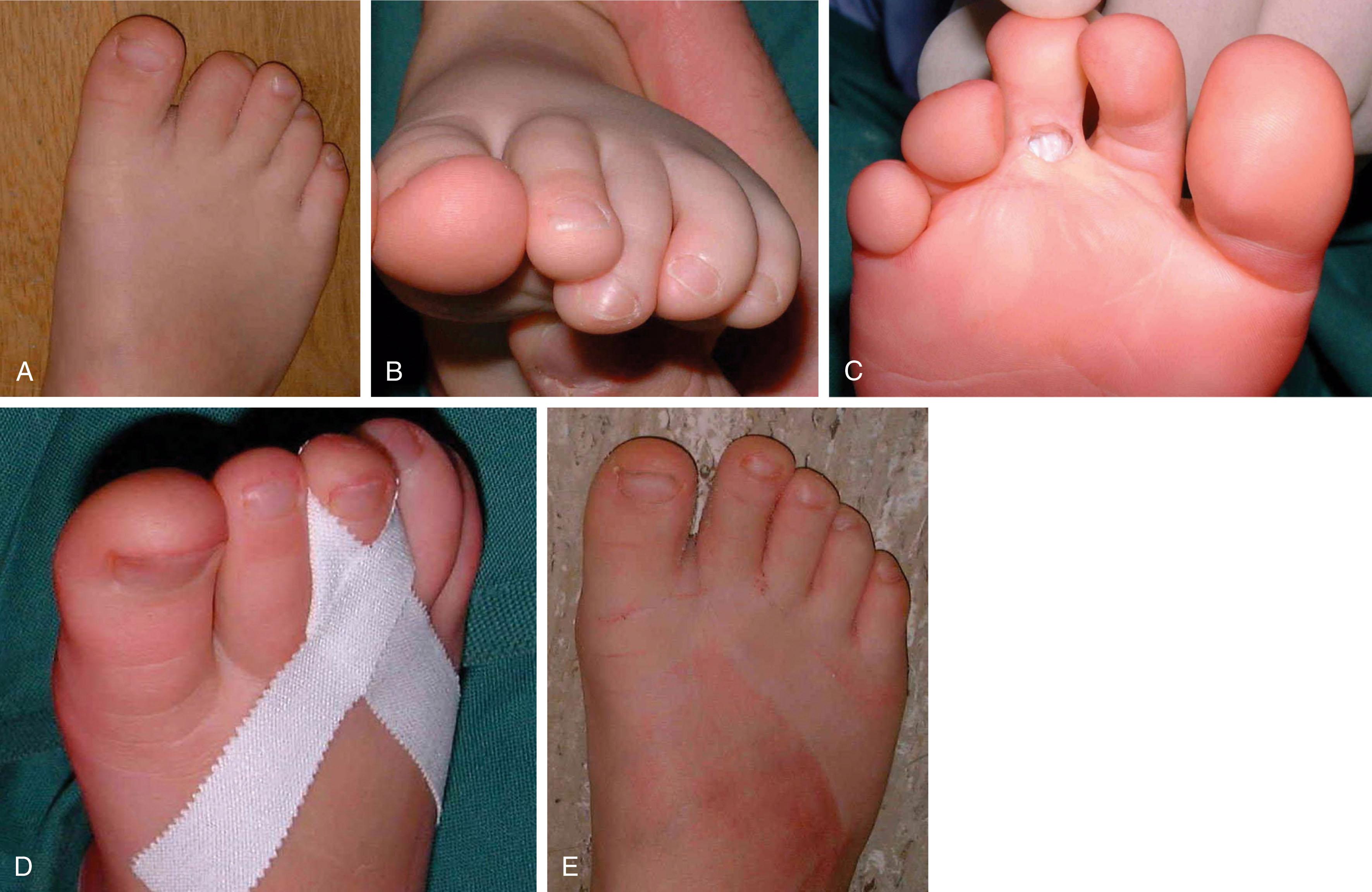 Fig. 9-66, Repair of curly toe deformity. A , Preoperative dorsal view demonstrating curly toe or contracture of the second toe. B , Preoperative frontal view demonstrating contracture of the third toe of another patient. C , Open lengthening of long flexor tendon of third toe. D , Postoperative taping of third digit for 6 weeks. E , Final result with correction of third toe curly toe deformity (preoperative from photograph A ).