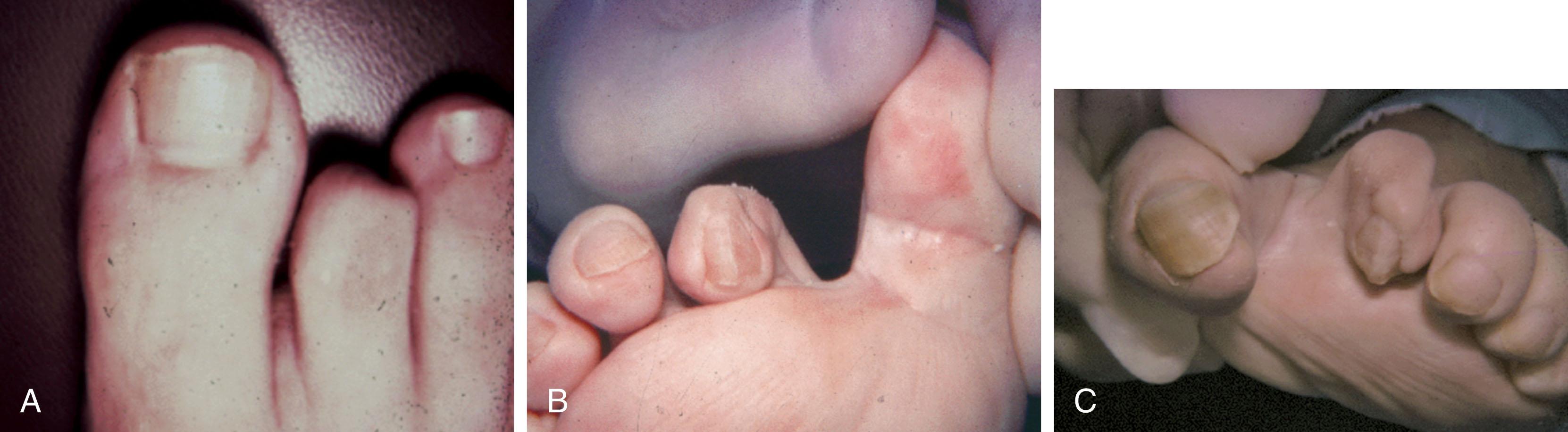 Fig. 9-67, Mallet toe deformity. A , Dorsal view. B , View end on. C , Plantar view of another patient with severe mallet toe deformity.