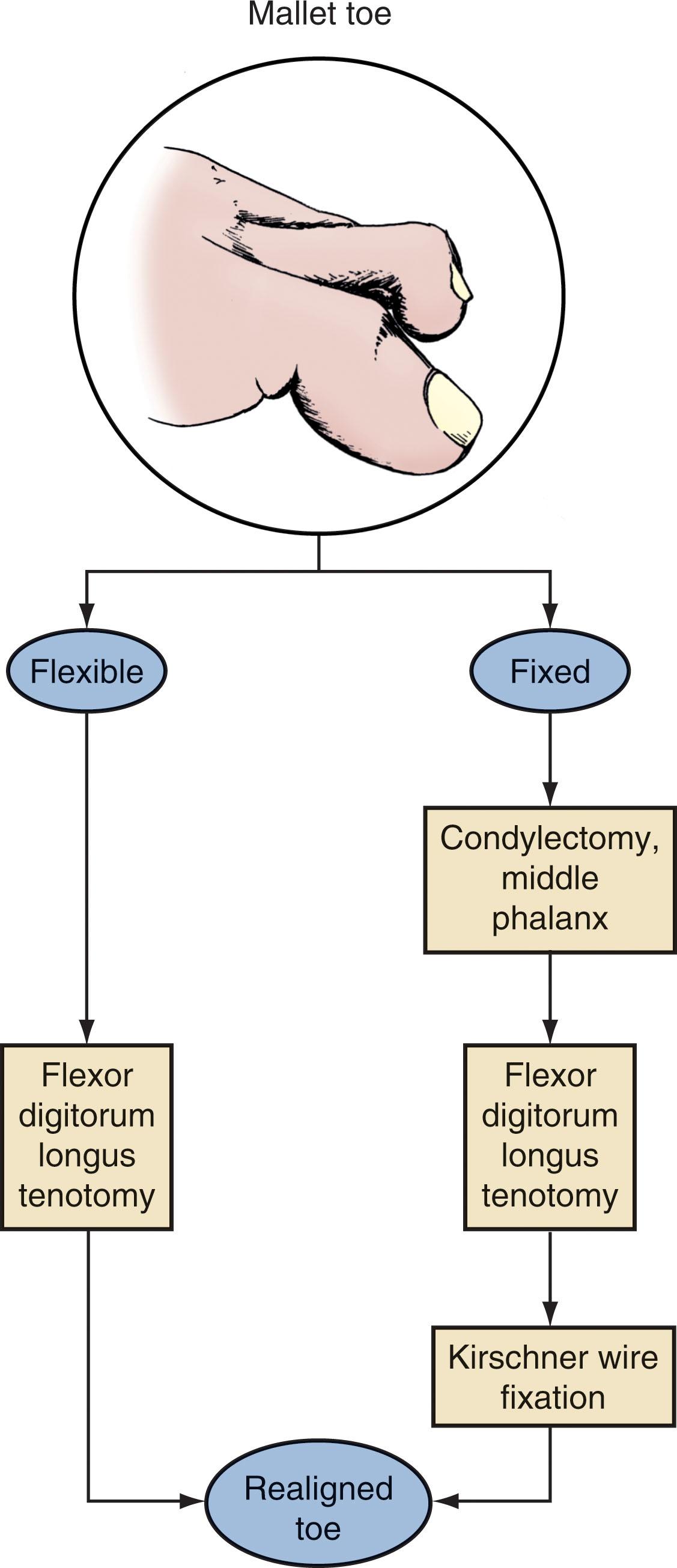 Fig. 9-68, Algorithm for treatment of mallet toe.