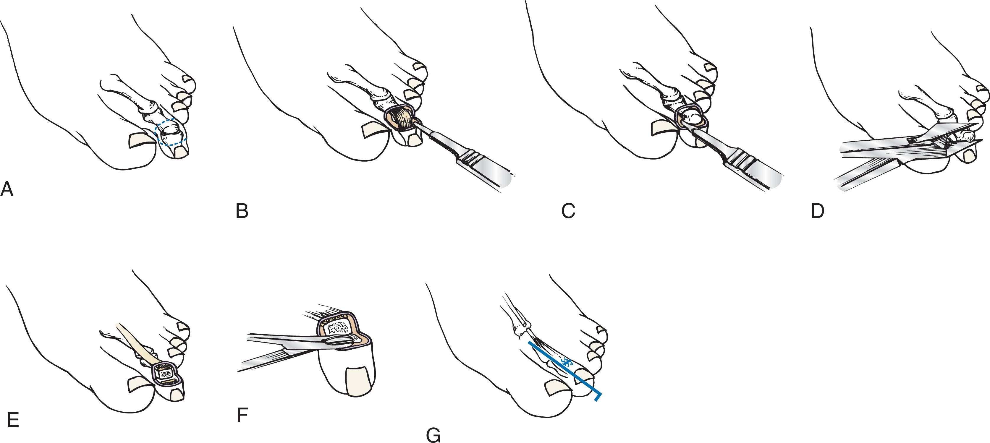 Fig. 9-69, Technique for correction of mallet toe deformity. A , Elliptic skin incision centered over the distal interphalangeal joint. B , Excision of skin, extensor tendon, and capsule, exposing condyles of middle phalanx. C , The collateral ligaments are severed, exposing the condyles of the middle phalanx. D , Generous excision of the distal portion of the middle phalanx. E , After resection of the condyle. F , The articular surface of the distal phalanx is removed with a rongeur. The flexor digitorum longus tendon is identified in the base of the wound and is released. G , Stabilization with intramedullary Kirschner wire. Vertical mattress sutures are used to coapt the skin.