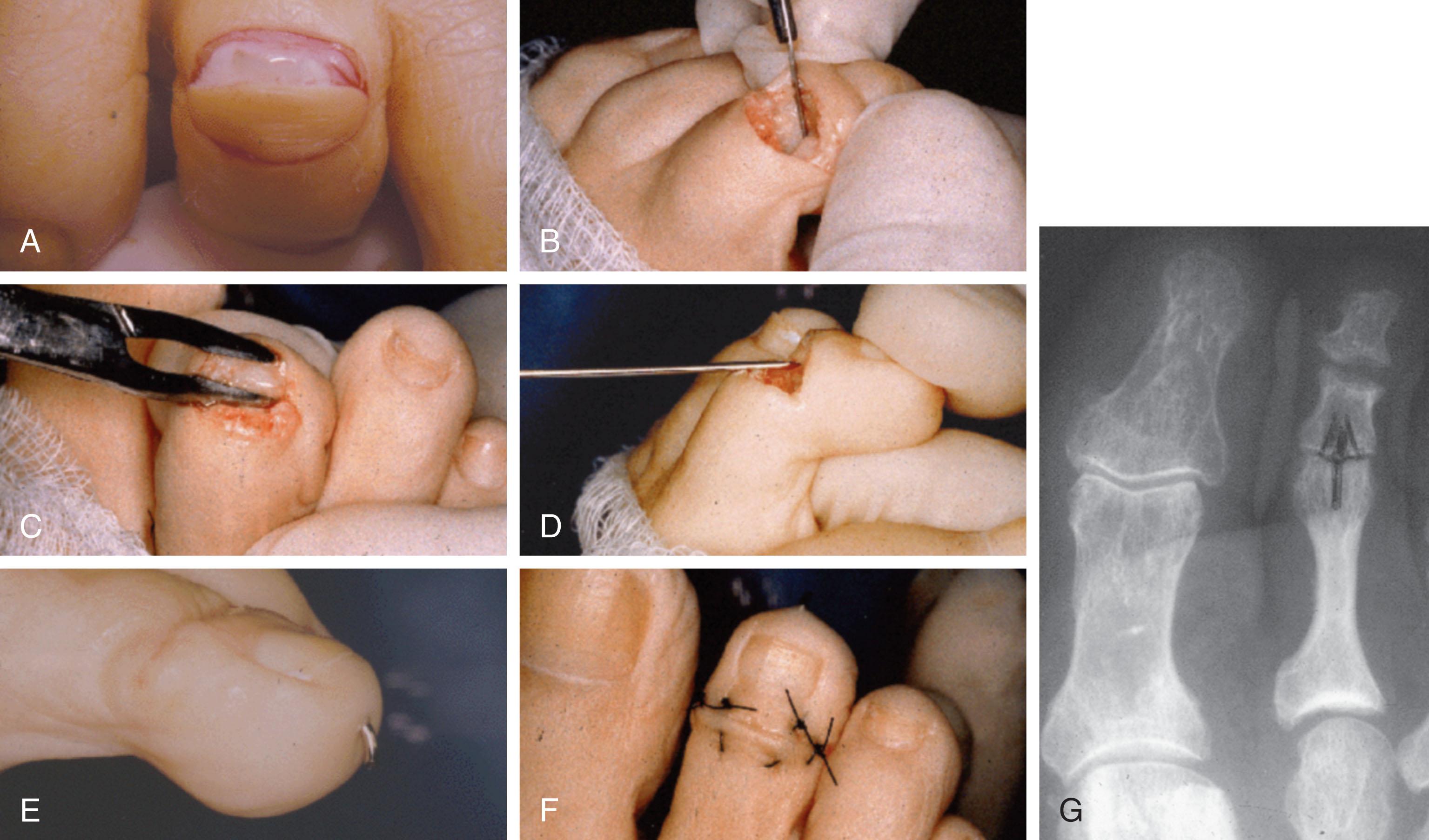 Fig. 9-70, Mallet toe repair. A , Dorsal elliptic incision. B , After condyles of the middle phalanx are resected, a flexor tenotomy is performed. C , The articular surface of the distal phalanx is removed (optional). D , Insertion of Kirschner wire. E and F , After Kirschner wire insertion and closure. G , Radiograph with stable and painless fibrous union of corrected mallet toe deformity of the second toe.