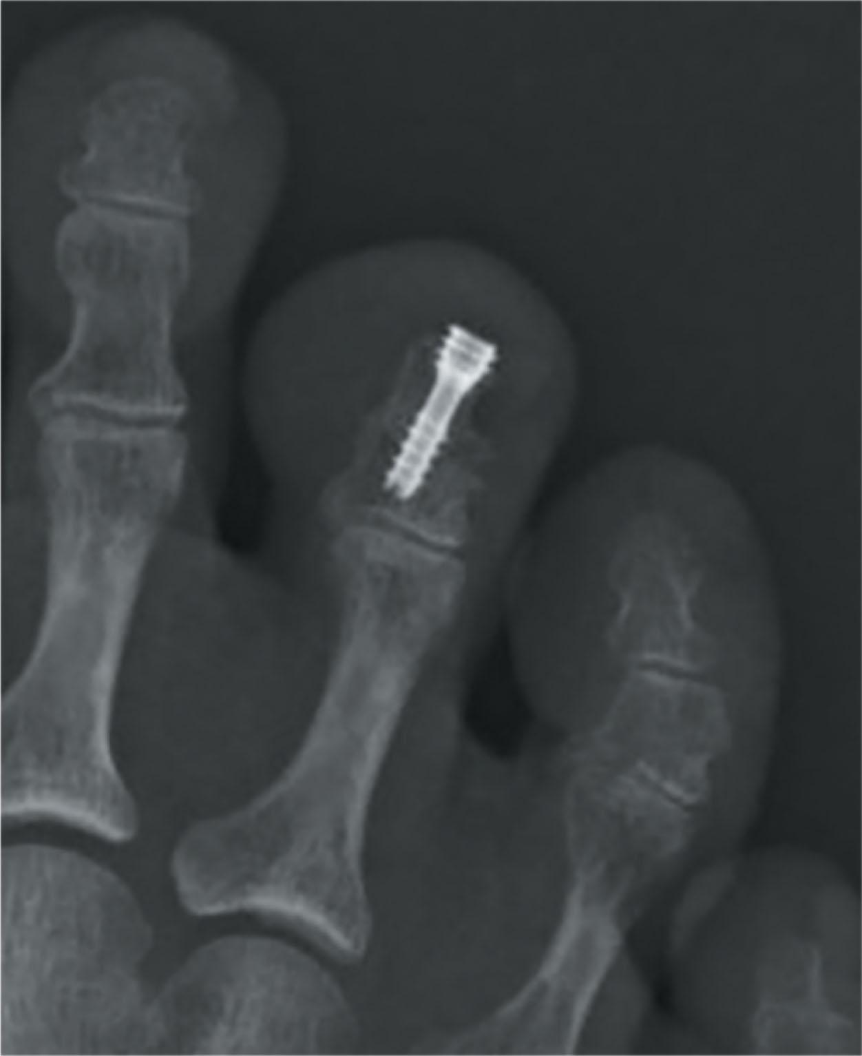 Fig. 9-71, 2.5-mm headless compression screw used as mallet toe fixation.