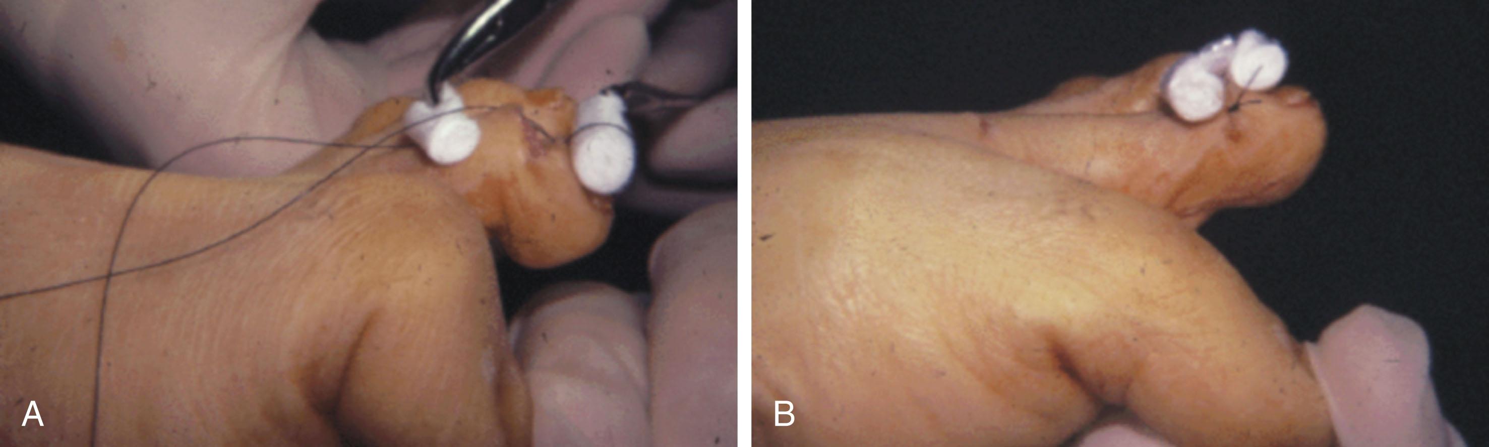 Fig. 9-72, Alternative means of fixation for mallet toe repair. A and B , Placement of Telfa bolsters beneath 3-0 nylon vertical mattress suture.