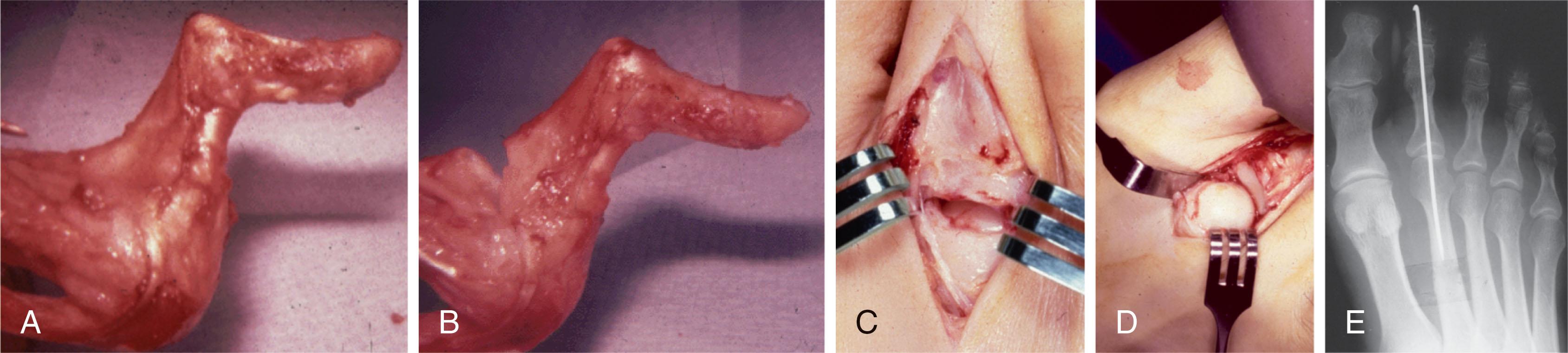 Fig. 9-75, Soft tissue release and realignment. A , Lateral view of a cadaver dissection demonstrating a fixed hammer toe deformity and a fixed contracture of the metatarsophalangeal joint. Note the lumbrical pulling at a right angle. Also note the thickness of the lateral capsule. B , An extensor tenotomy and dorsal capsule release have been performed. This is an inadequate release to reduce the toe, as can be seen in this dissection. Note that a more extensive capsule release must be performed on the medial and lateral aspect to reduce the toe. C , Intraoperative photograph demonstrating inadequate release. D , An adequate capsule release has been performed. E , After metatarsophalangeal joint release, often intermedullary Kirschner wire fixation is used to stabilize the repair.