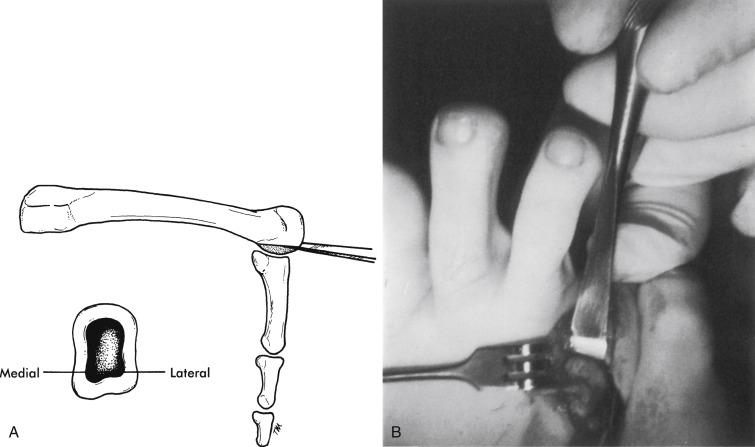 Fig. 20.12, (A) Plantar condylectomy for a discrete intractable plantar keratosis. (B) Interoperative view of plantar condylectomy (one-fourth to one-third of the plantar metatarsal head is excised).