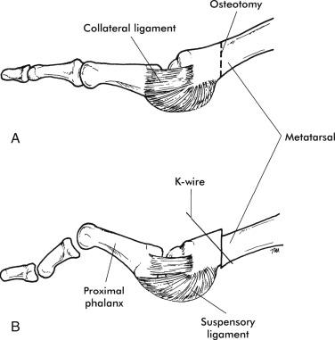Fig. 20.13, (A) Distal oblique osteotomy ( dotted line shows proposed osteotomy site). (B) Following displacement and internal fixation with K-wire.