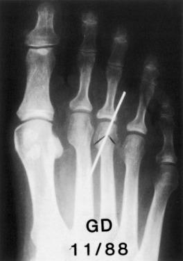 Fig. 20.14, Distal chevron osteotomy with internal fixation.