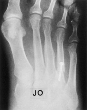 Fig. 20.15, Proximal closing wedge osteotomy with screw fixation.