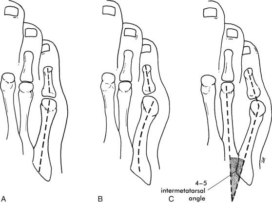 Fig. 20.3, (A) Bunionette with enlarged fifth metatarsal head. (B) Bunionette with bowing of the metaphysis. (C) Bunionette with enlarged 4‒5 intermetatarsal angle.