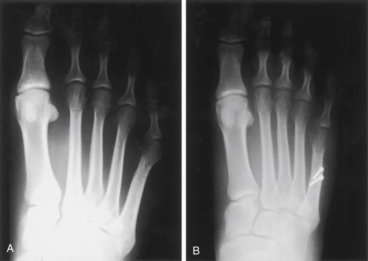 Fig. 20.4, Case study 1. (A) Bunionette preoperative x-rays. (B) Follow-up x-rays demonstrating correction.