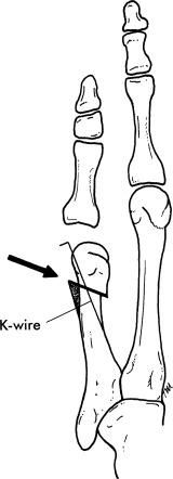 Fig. 20.7, Distal oblique osteotomy with K-wire fixation ( shaded area denotes shaved bone in metaphysic).