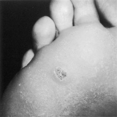 Fig. 20.10, A wart is characterized by punctate hemorrhages, which are obvious when the callus is trimmed.