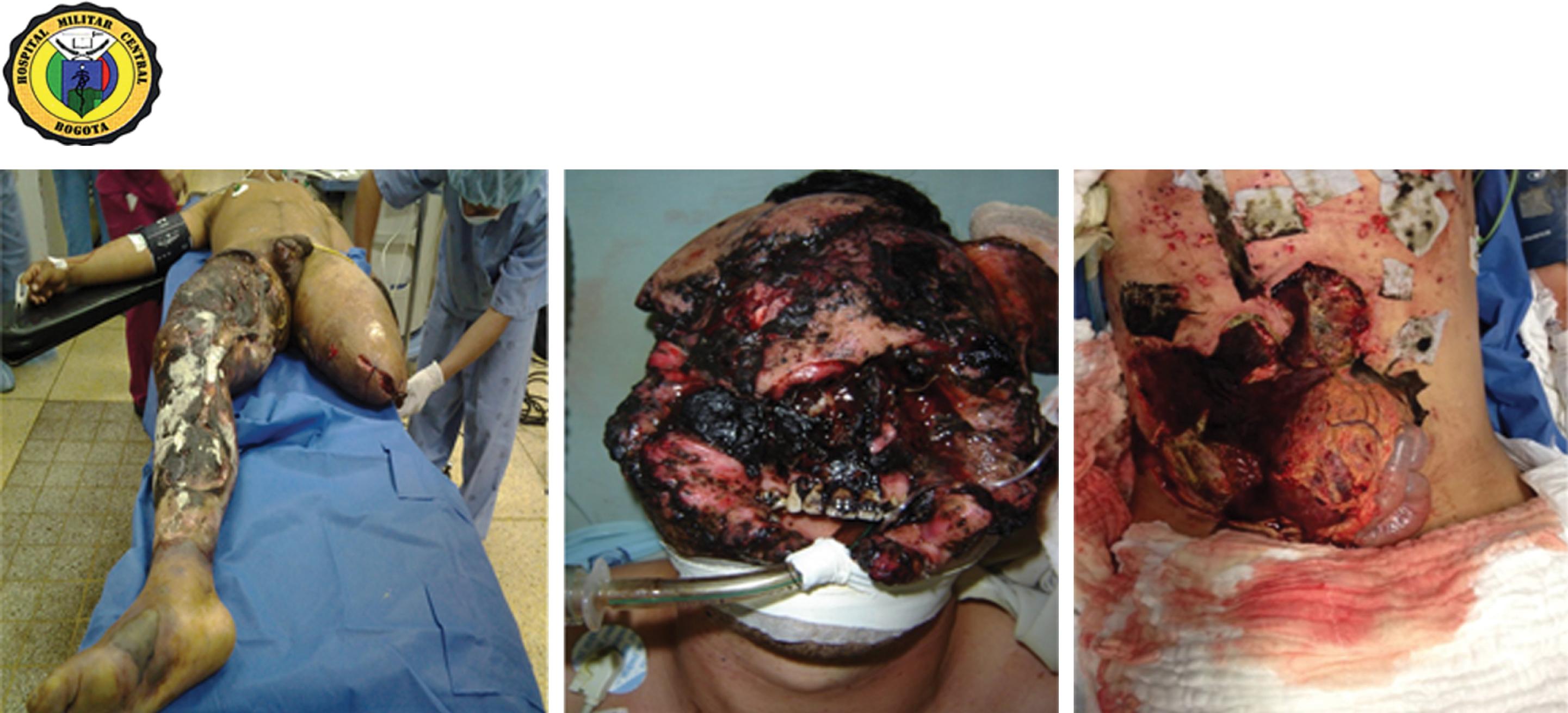 FIGURE 2, Soldiers wounded in combat with amputations, burns, and severe soft tissue injury.