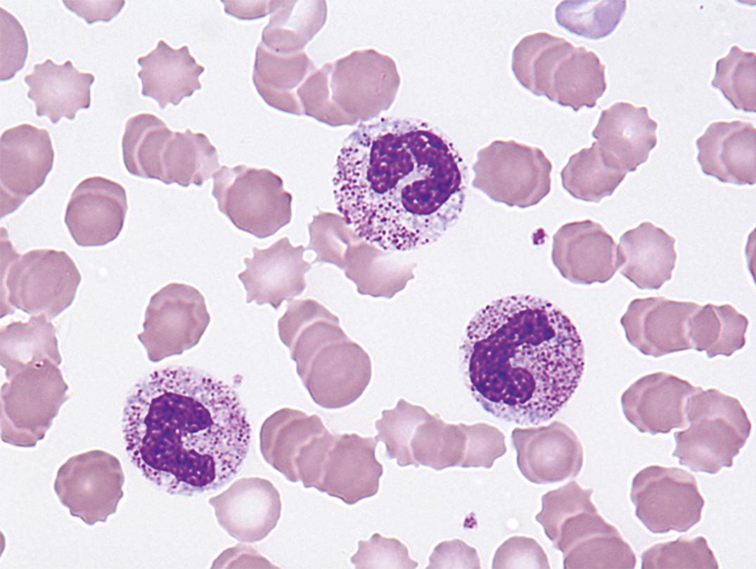 Figure 34.1, A neutrophil with toxic granulation is pictured, along with two bands. Basophilic inclusions (Döhle bodies) are present as well (× 1000).