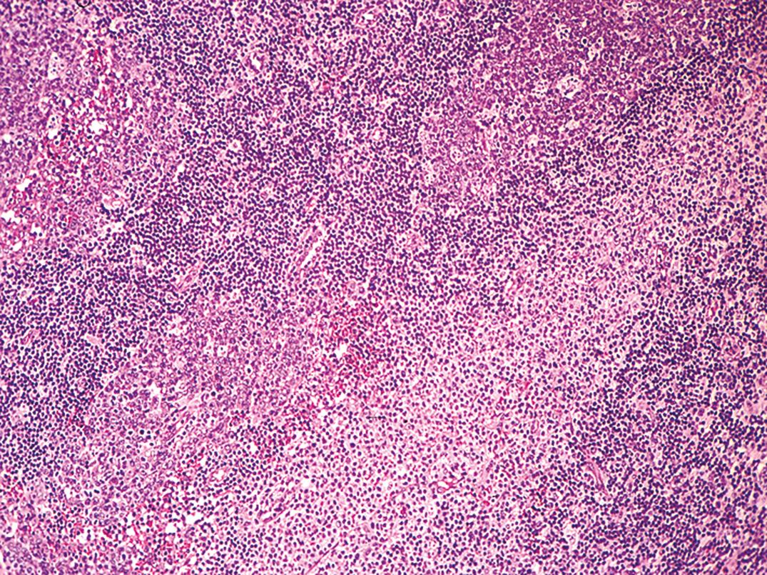 Figure 34.11, Toxoplasmosis lymphadenitis shows follicular hyperplasia with monocytoid B-cell hyperplasia (lower right-center) and scattered individual and aggregates of histiocytes, often impinging on the germinal center/mantle zone border (×200).