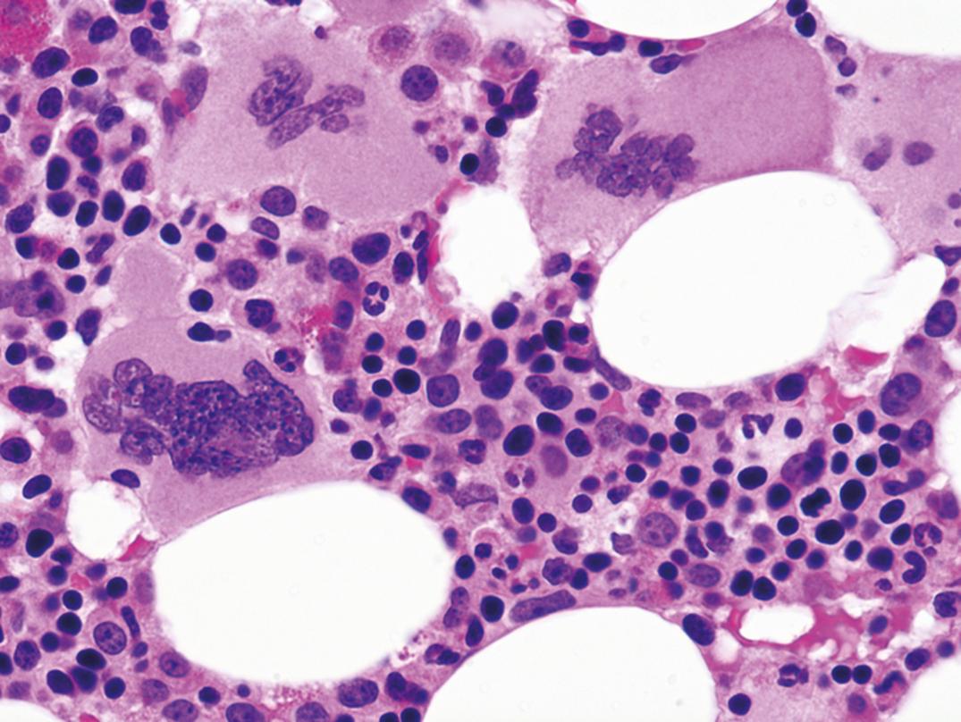 Figure 34.13, Bone marrow biopsy in polycythemia vera shows panmyelosis with normoblastic hyperplasia (×500).