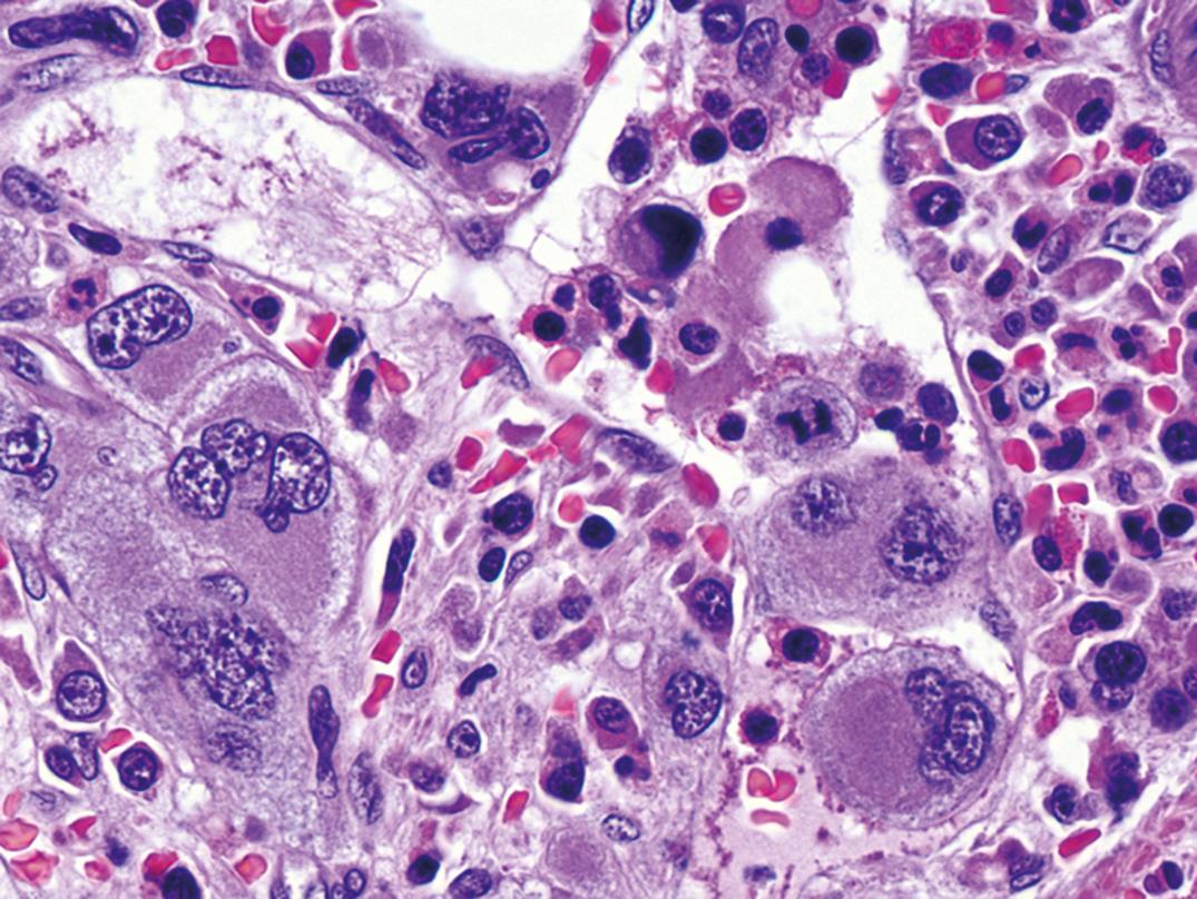 Figure 34.14, Bone marrow biopsy in primary myelofibrosis, with increased spacing between cells suggesting fibrosis and intrasinusoidal hematopoiesis (×500).