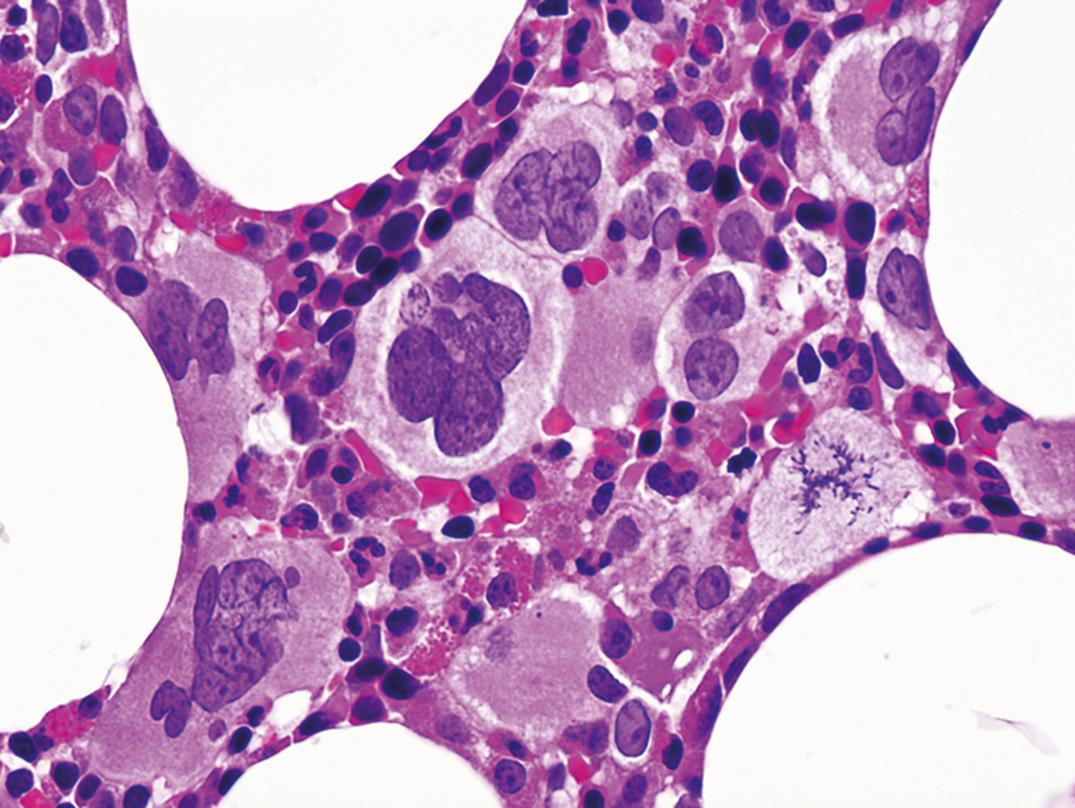 Figure 34.15, Bone marrow biopsy in essential thrombocythemia, with increased and clustered megakaryocytes (×500). Nuclei in this case are unusual, resembling primary myelofibrosis.