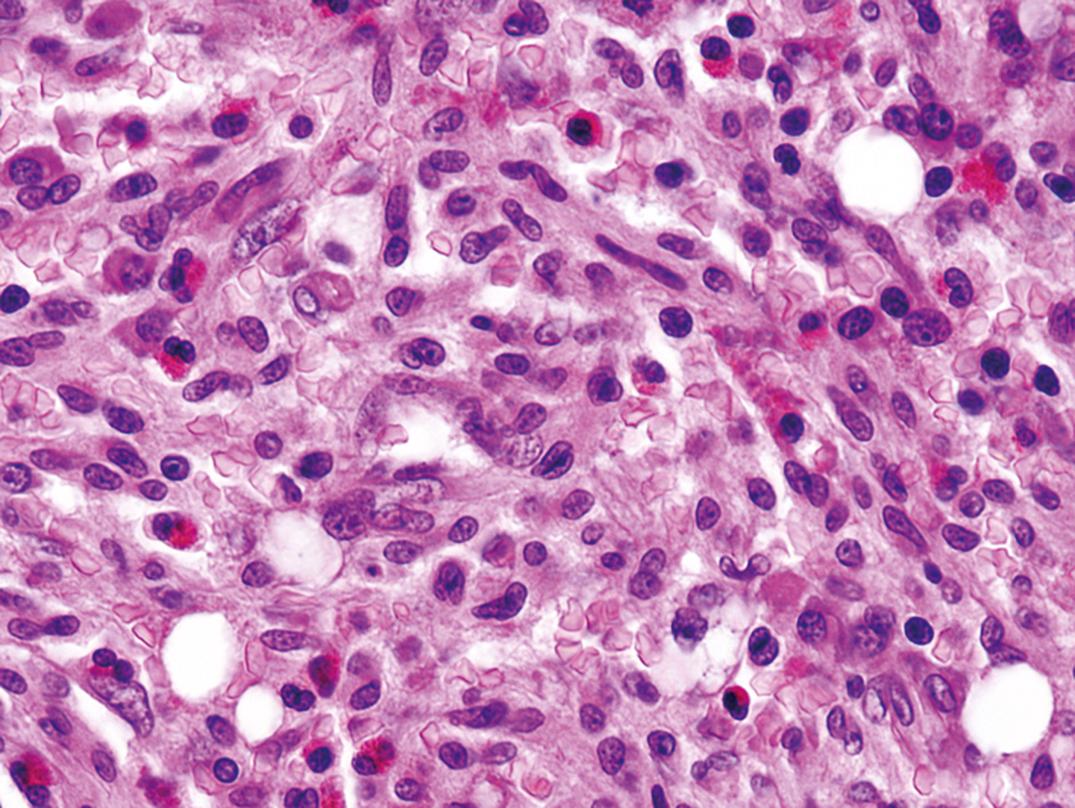 Figure 34.16, Mastocytosis in the bone marrow, presenting after treatment for acute myeloid leukemia (×500).