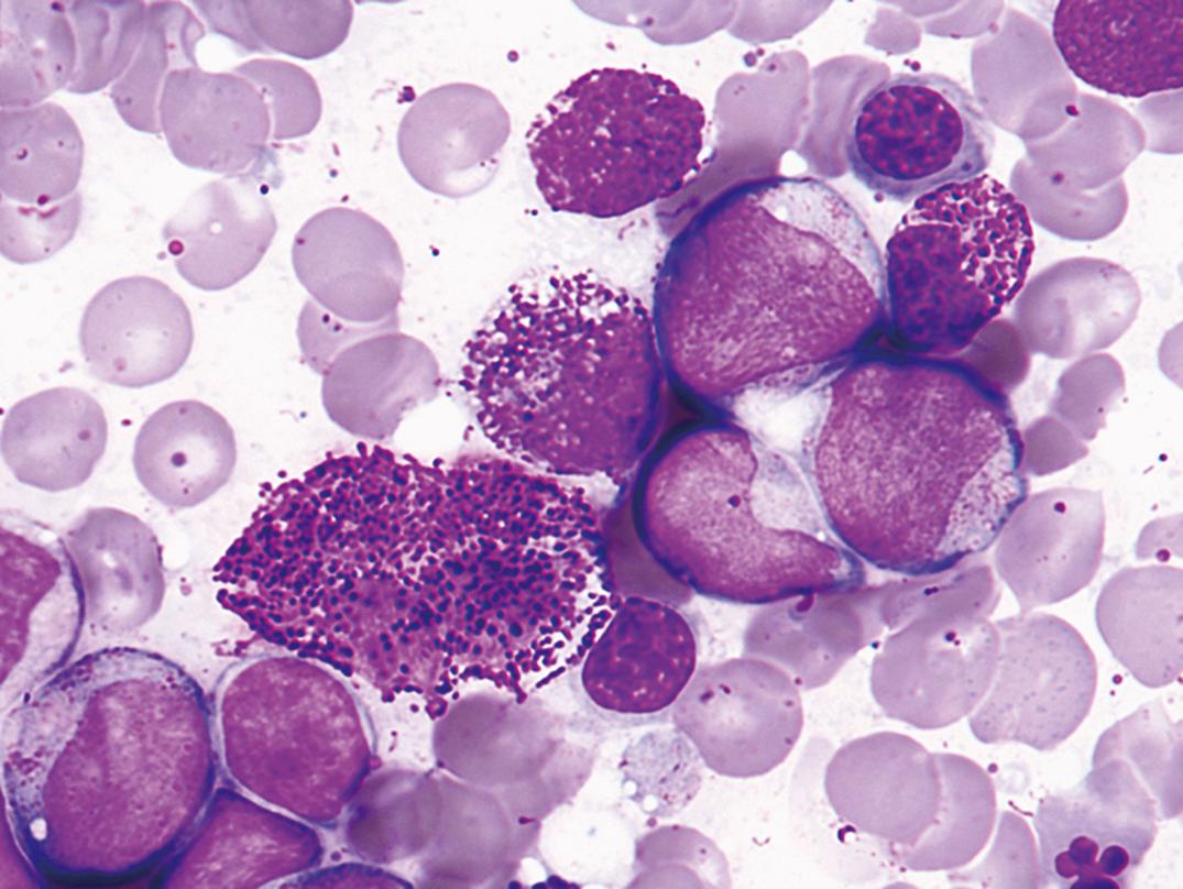 Figure 34.17, Acute leukemia with early mast cell disease before therapy (earlier specimen from case shown in Fig. 34.16) (×1000).