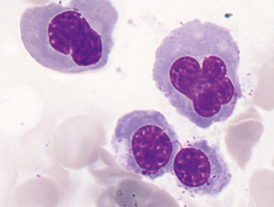 Figure 34.18, Drug-induced dyserythropoiesis, with irregular nuclear lobation in the cells above right, compared with two relatively normal normoblasts (×1000).