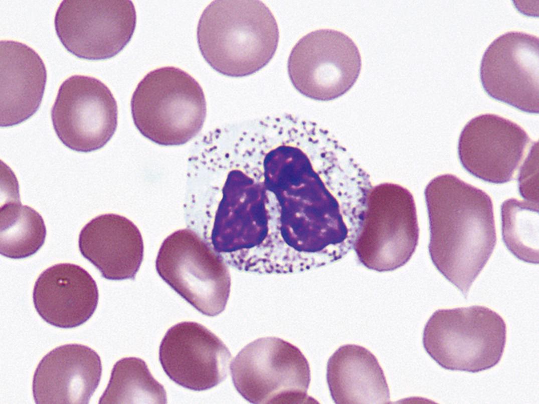 Figure 34.20, Pseudo–Pelger-Huët neutrophil (×1000).