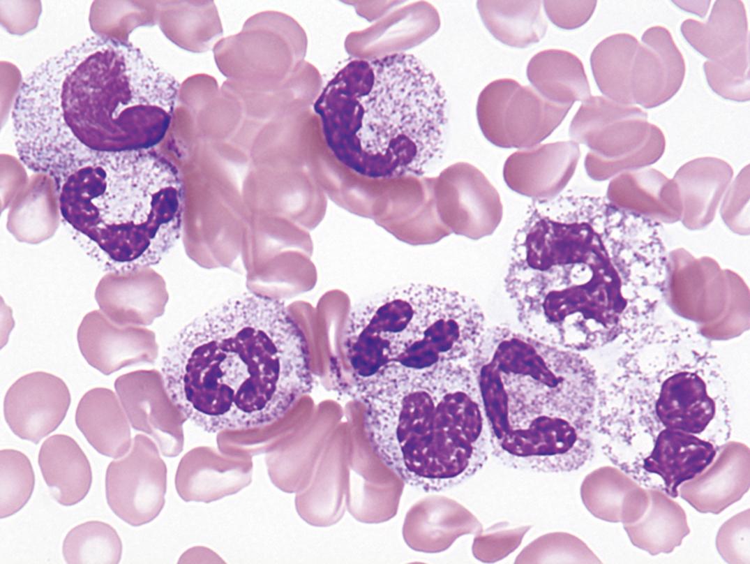 Figure 34.2, Leukemoid toxic neutrophilia with left shift and toxic vacuolization (×1000).